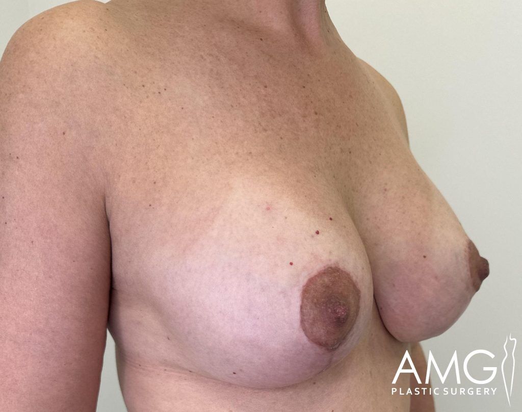 Person's chest showing post-surgery healing with visible stitches or marks. A logo in the corner reads "AMG Plastic Surgery.