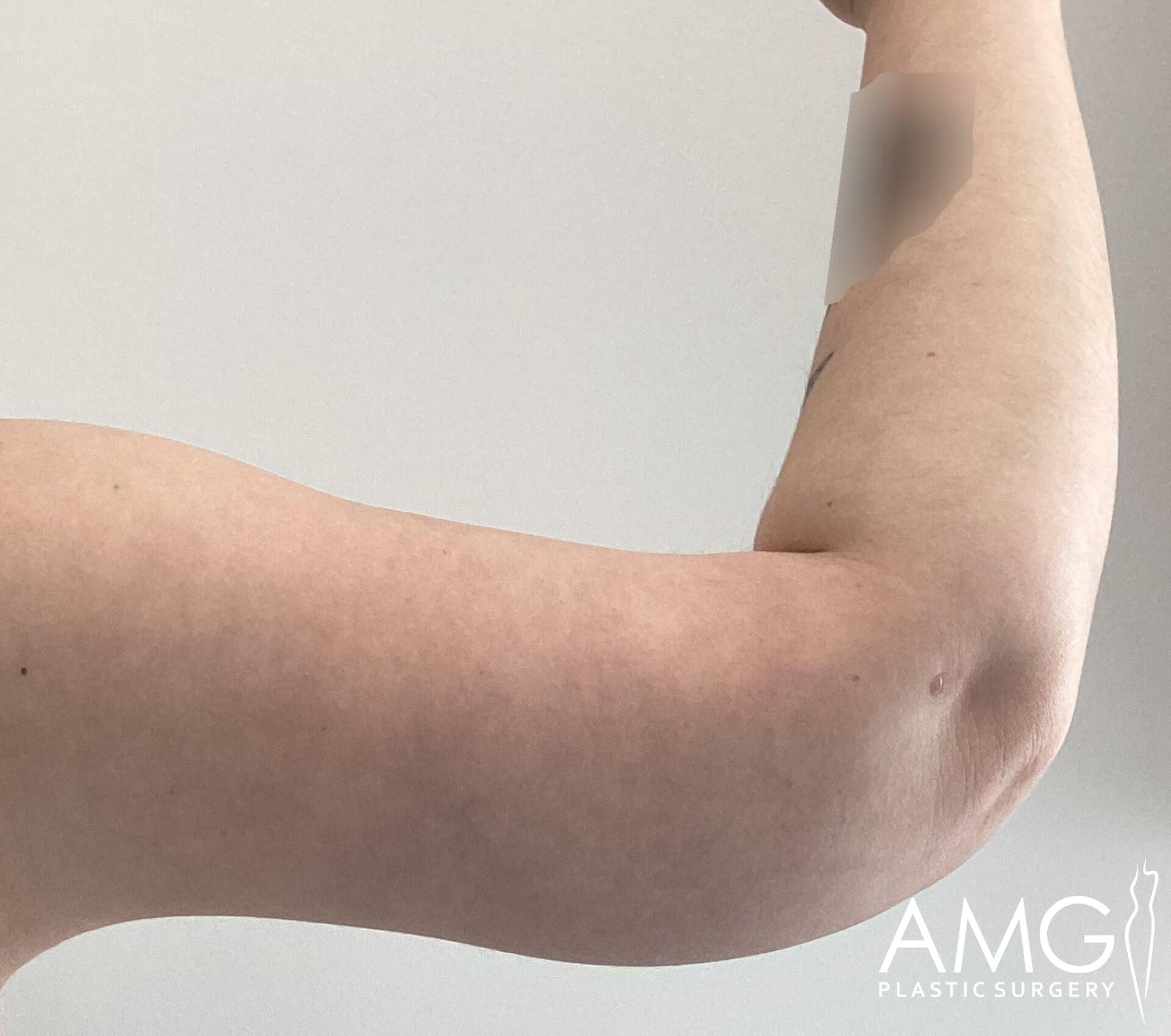 Close-up of a person's flexed arm showing a tattoo that is partially covered. The image includes AMG Plastic Surgery branding.