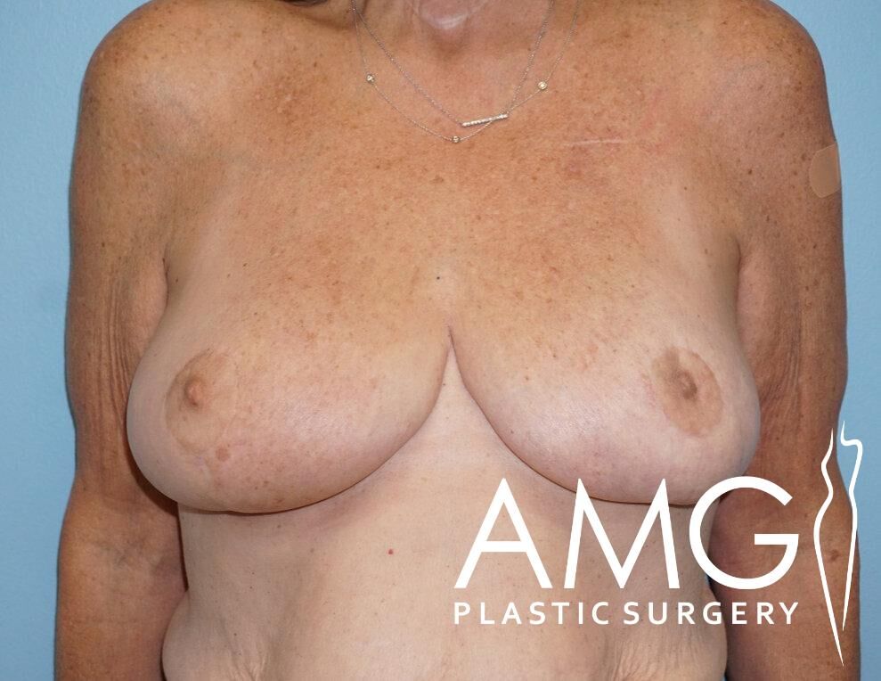 A person with a bare torso showing breast surgery results, featuring tan skin and a visible logo for AMG Plastic Surgery.