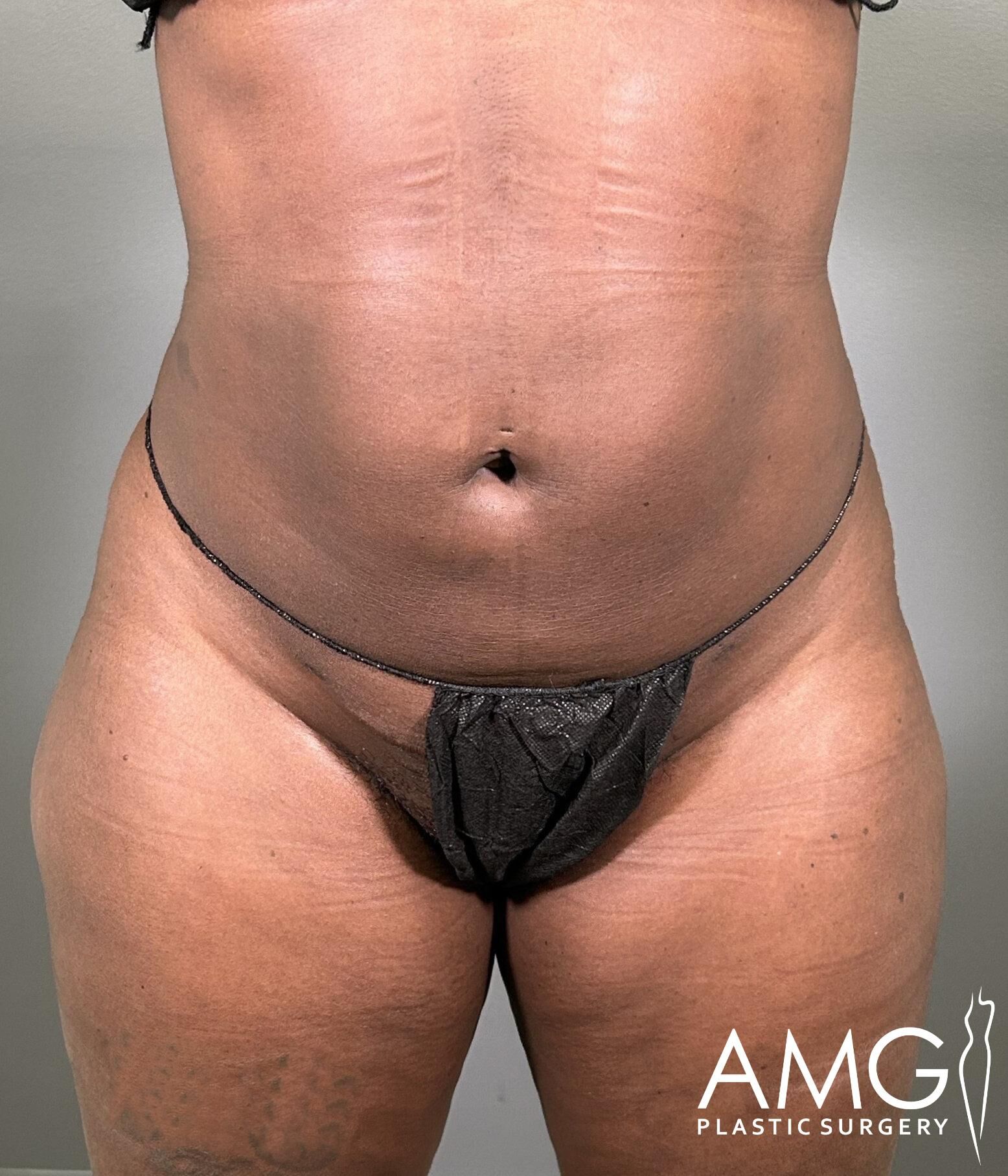 Person's torso wearing a black garment, showing skin texture and contour. The image has a "AMG Plastic Surgery" watermark in the bottom right.