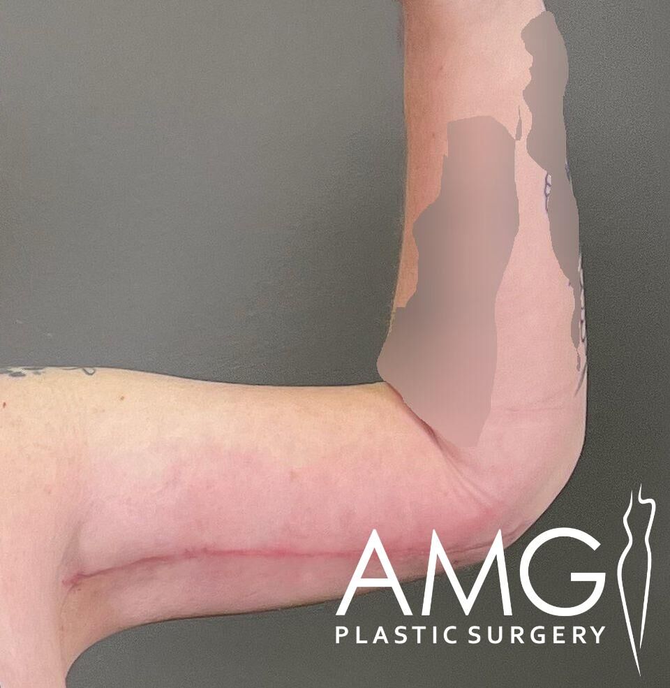 An arm after plastic surgery with visible incisions and bandages. Logo reads "AMG Plastic Surgery.
