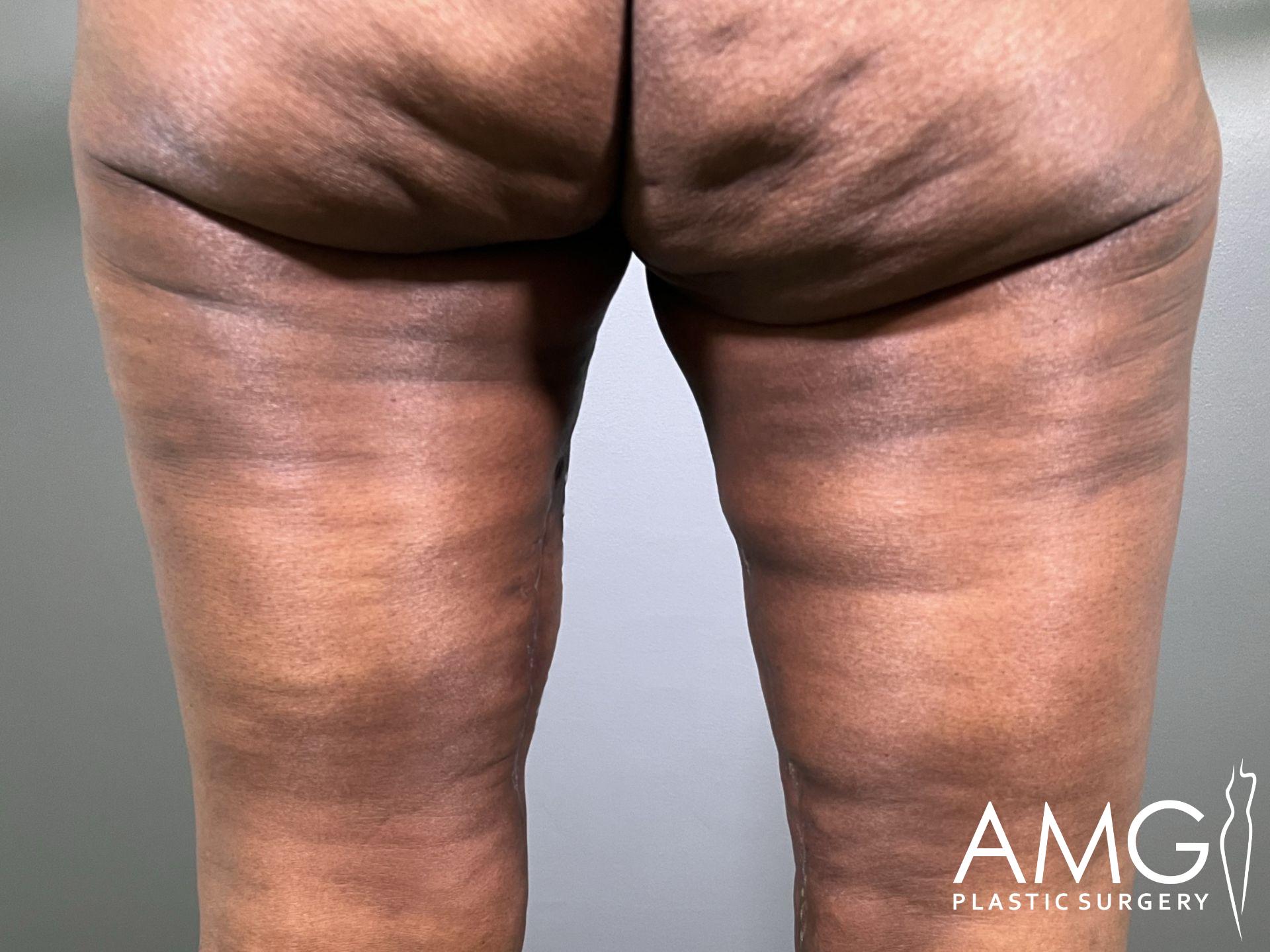 The image shows the back of a person's thighs with visible skin folds and texture. The AMG Plastic Surgery logo is in the corner.