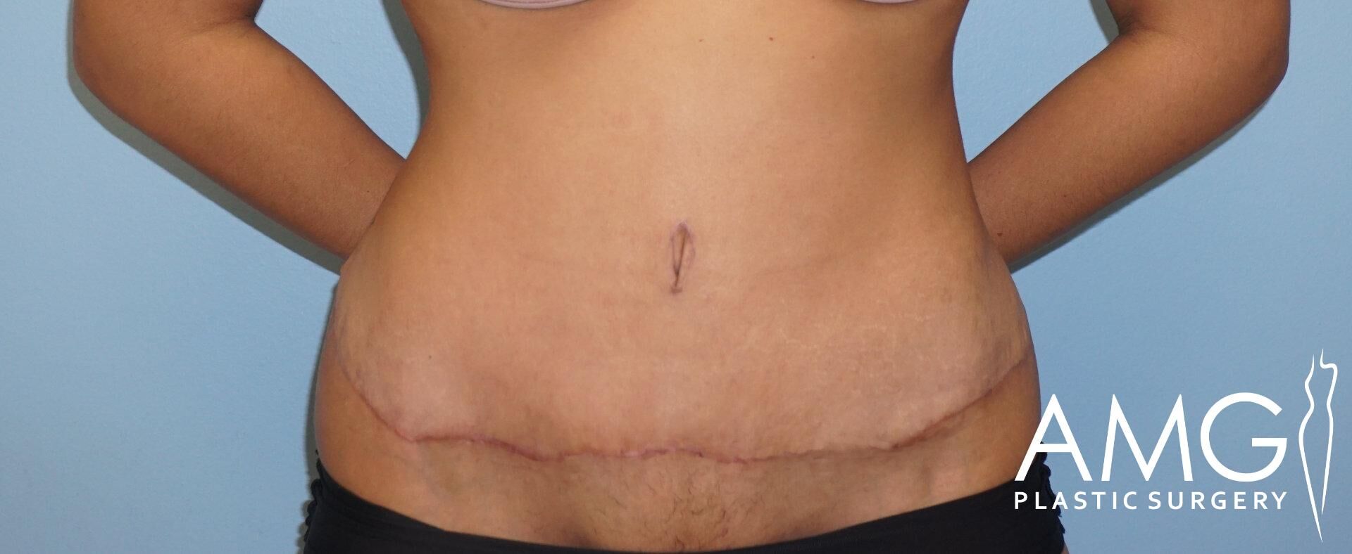 Person's abdomen with a surgical scar in a curved line. Blue background with "AMG Plastic Surgery" logo in the bottom right corner.