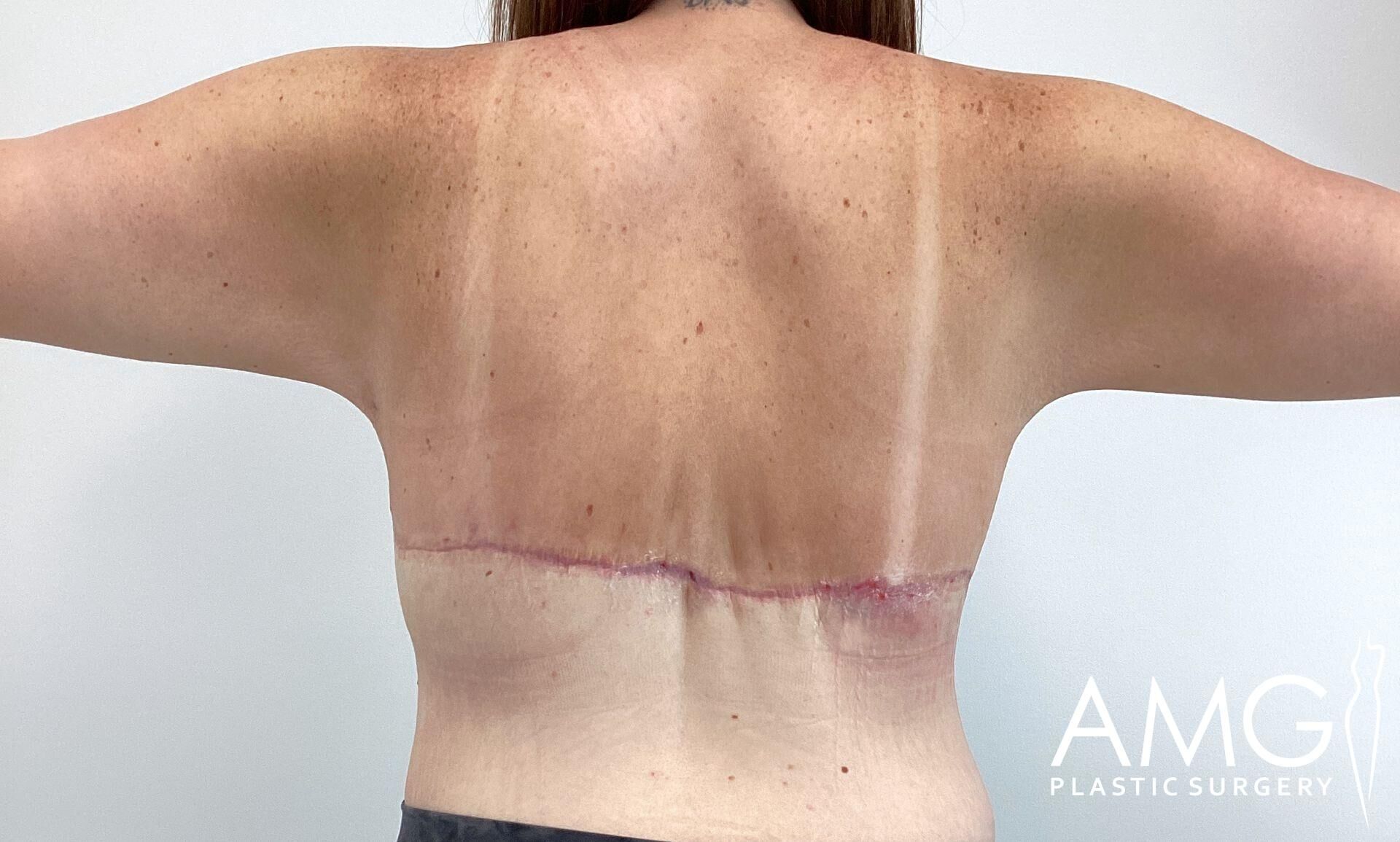Person's back with a surgical scar extending horizontally, surrounded by redness. The marking of past bra straps is visible. Logo reads 