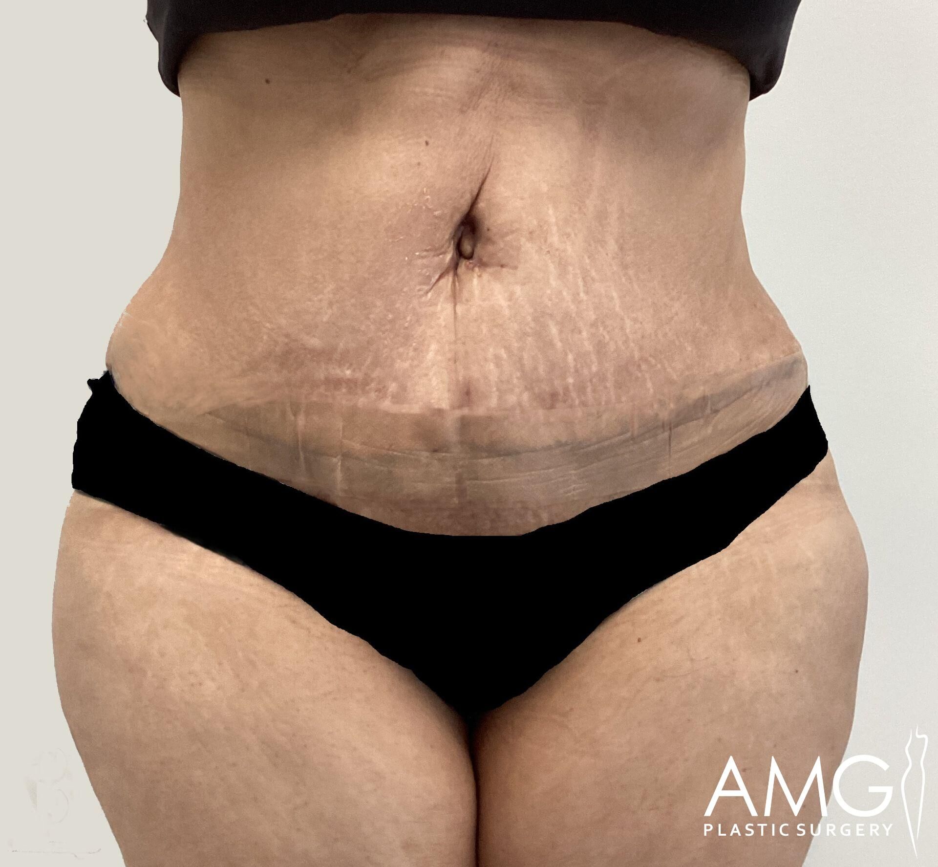 A person stands facing forward, wearing black undergarments. The midsection shows skin texture and stretch marks. The text "AMG Plastic Surgery" is printed on the image.