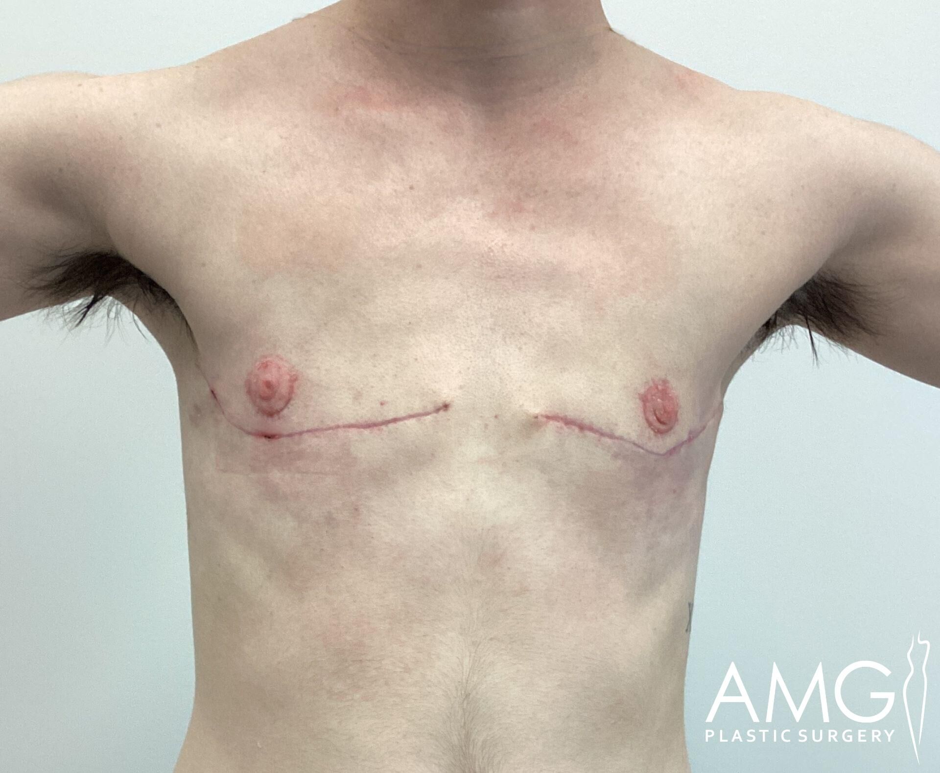 Person's chest showing healing scars under each nipple, indicating recent surgery. Arms are slightly raised. Logo in the bottom right corner reads "AMG Plastic Surgery.