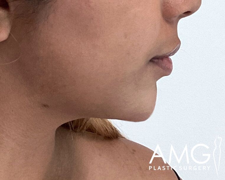 Profile view of a person's chin and lower face against a neutral background. "AMG Plastic Surgery" logo in the lower right corner.
