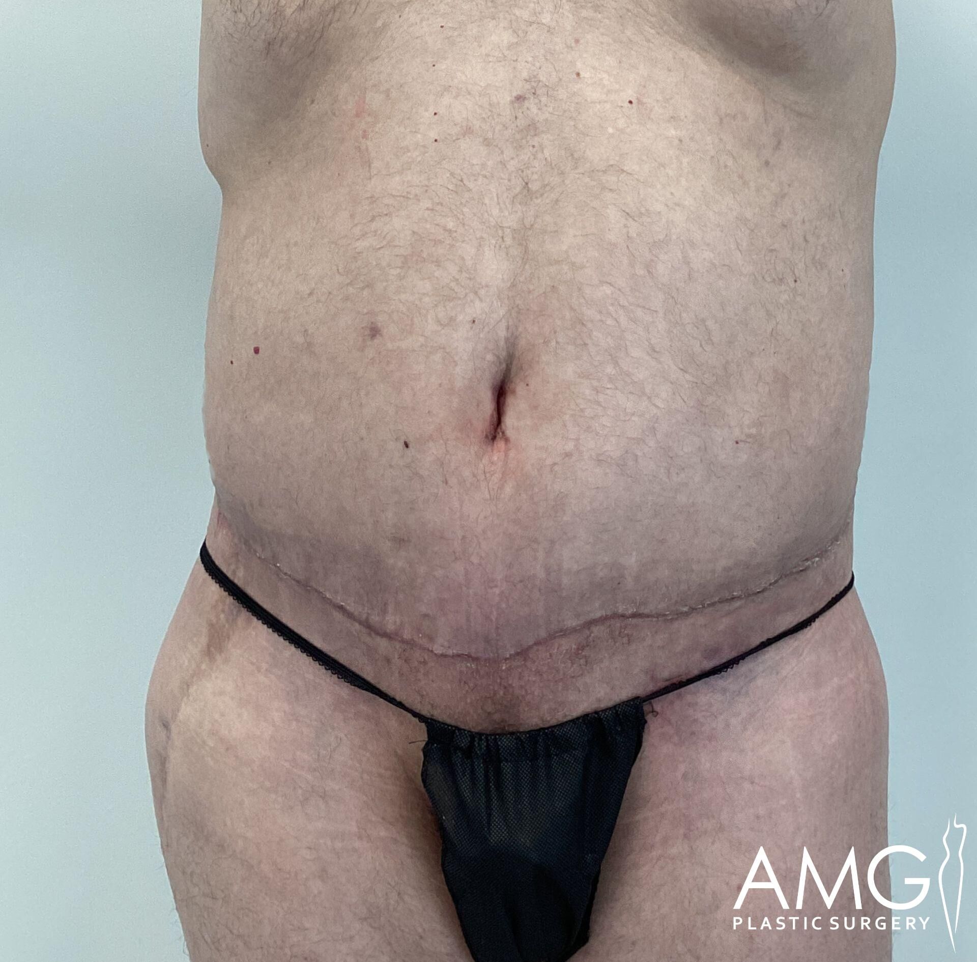 A close-up of a person's abdomen showing a healing scar, wearing dark undergarments. The image is branded with a plastic surgery clinic's logo.