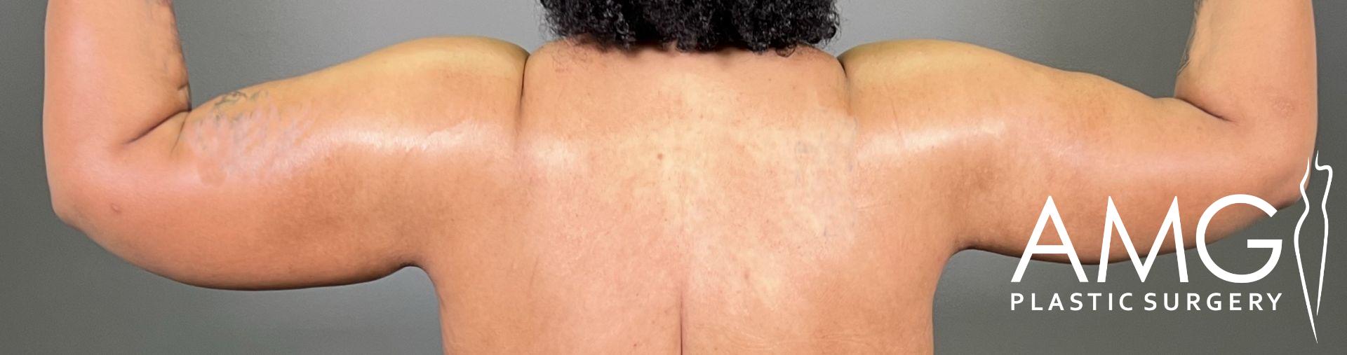 A person flexes their arms with visible stretch marks, displaying strong muscles. Logo on the right reads 