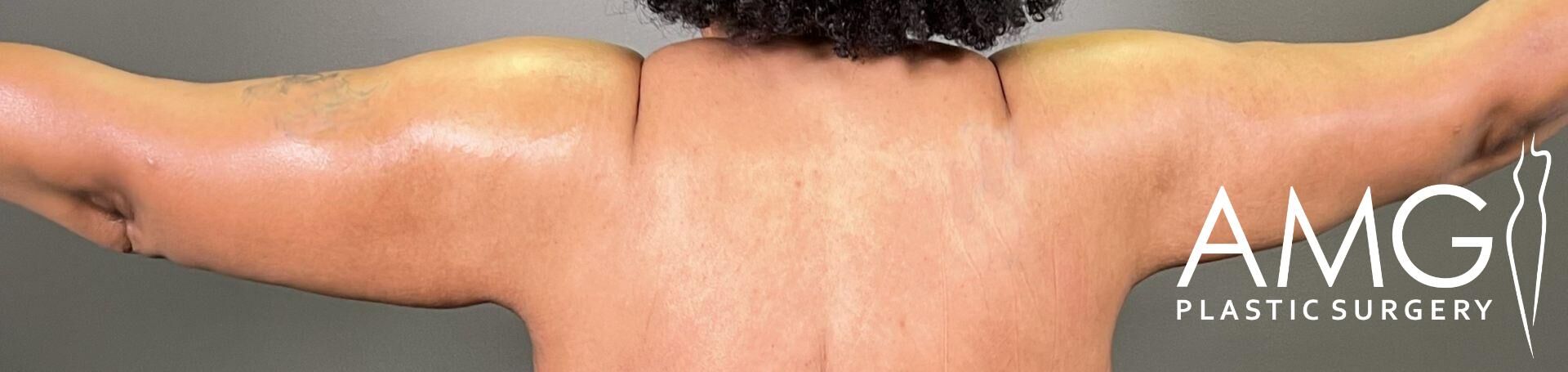 A person with arms raised, showing their back, with the logo "AMG Plastic Surgery" in the bottom right corner.