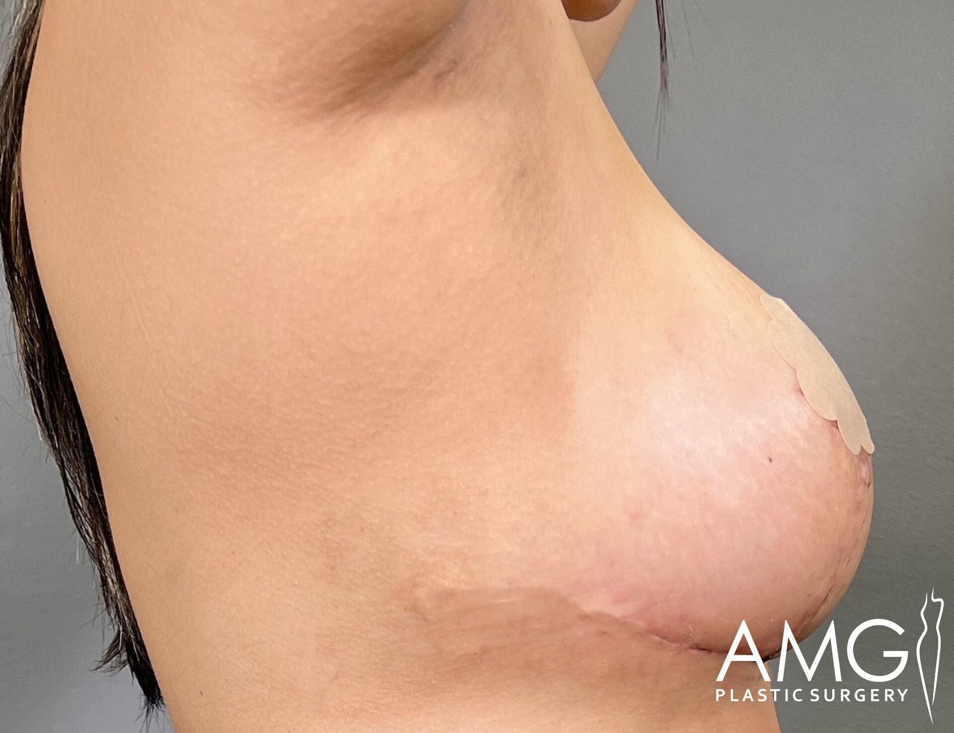 Side view of a breast with visible skin irritation and an incisional scar on the lower curve. Logo "AMG Plastic Surgery" in the lower right corner.