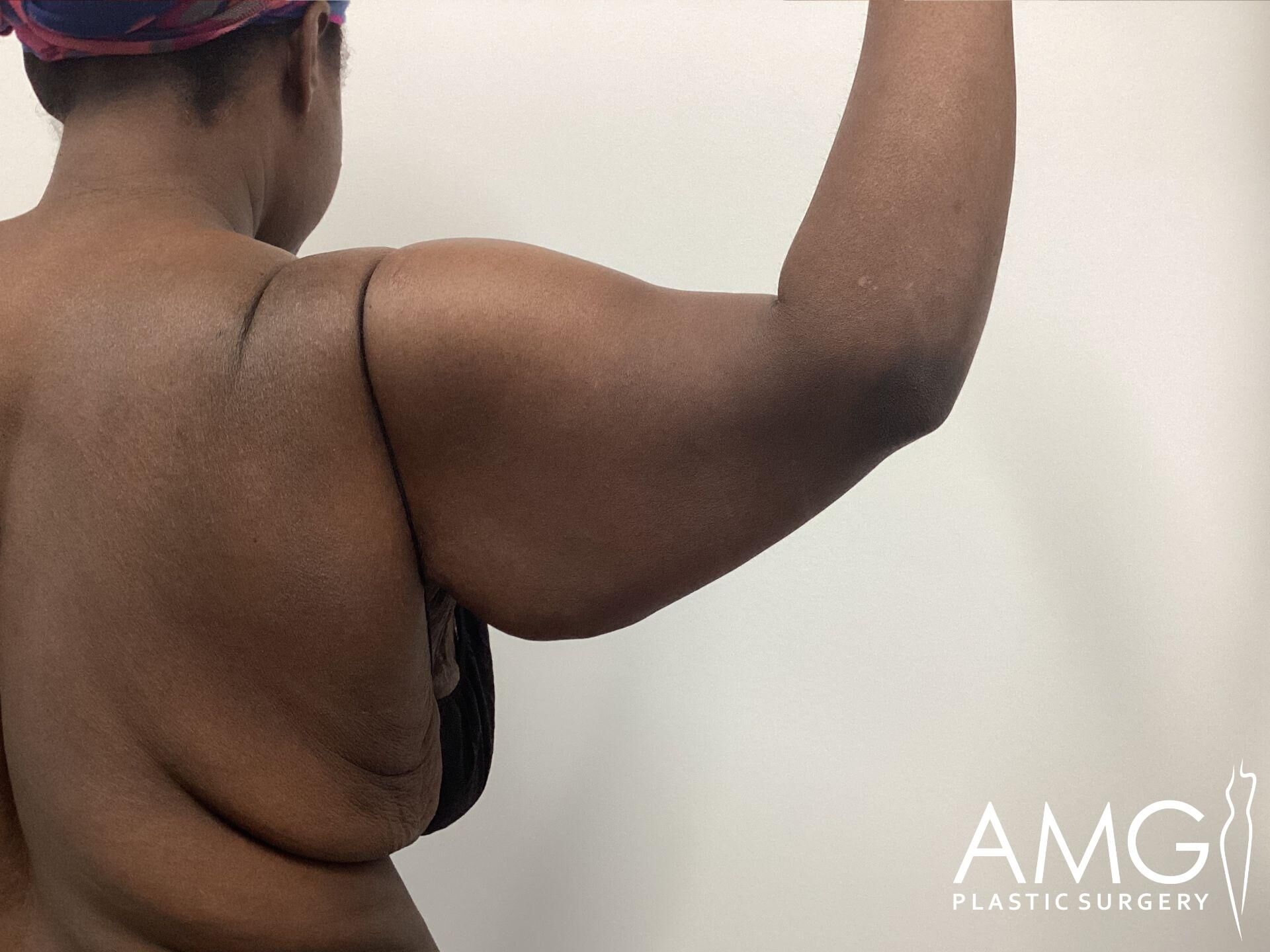 A person flexes their right arm in a side view, showing the upper back and arm area. The image has a white background, with 