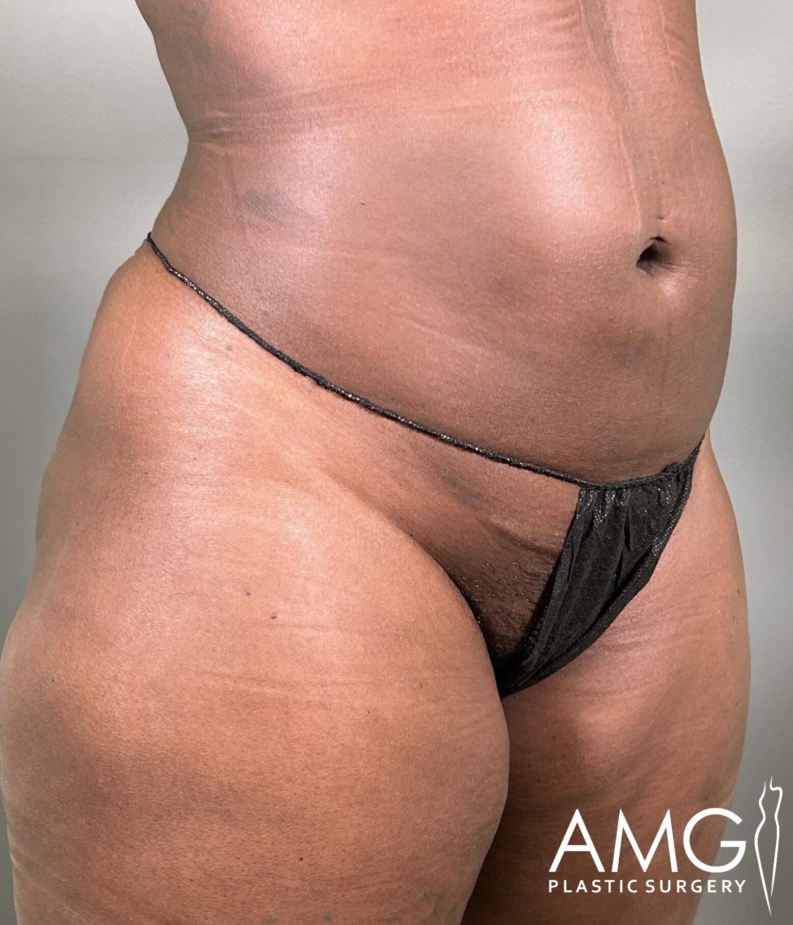Lower body of a person in a black bikini bottom, with visible stretch marks and skin texture. Logo reads "AMG Plastic Surgery" in the bottom right corner.