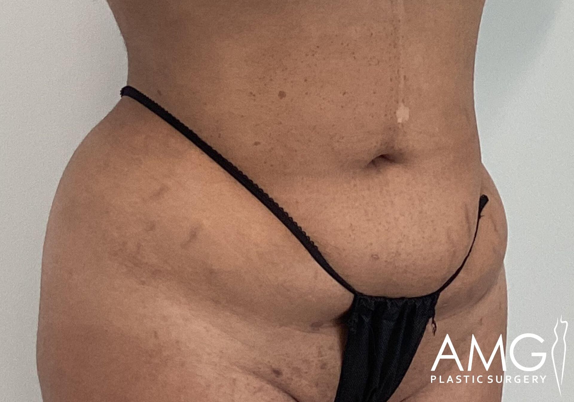 Close-up of a person's midsection wearing a black string bikini. The image shows skin texture and an AMG Plastic Surgery watermark in the bottom right corner.