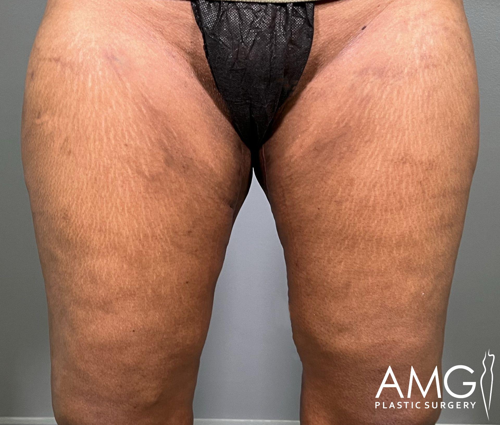 Thighs with visible stretch marks and skin texture, wearing black undergarments. Logo in bottom right corner reads 