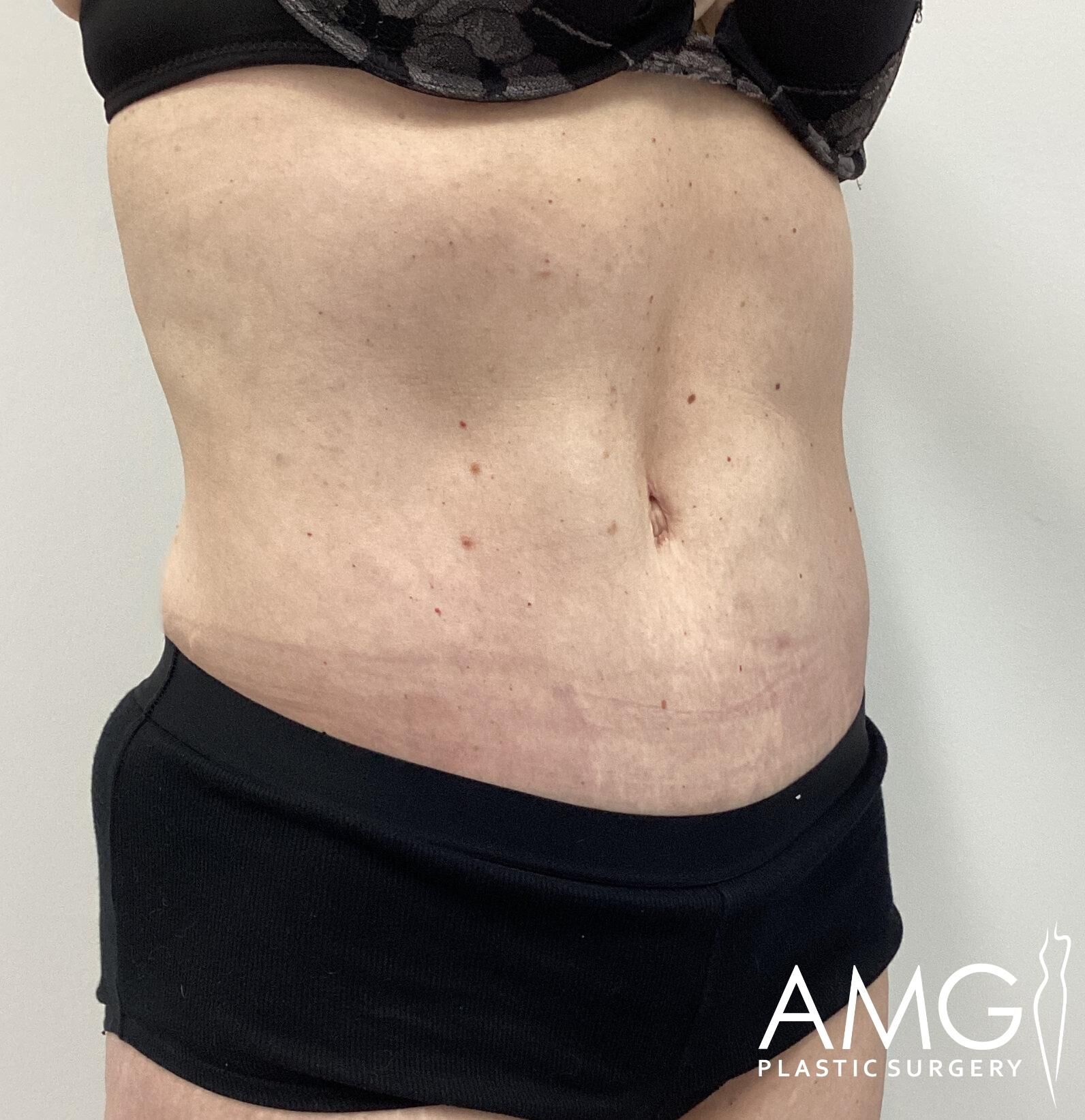 Profile view of a person's torso and abdomen wearing a bra and shorts, with visible surgical or stretch marks. The image has a logo in the corner reading "AMG Plastic Surgery.