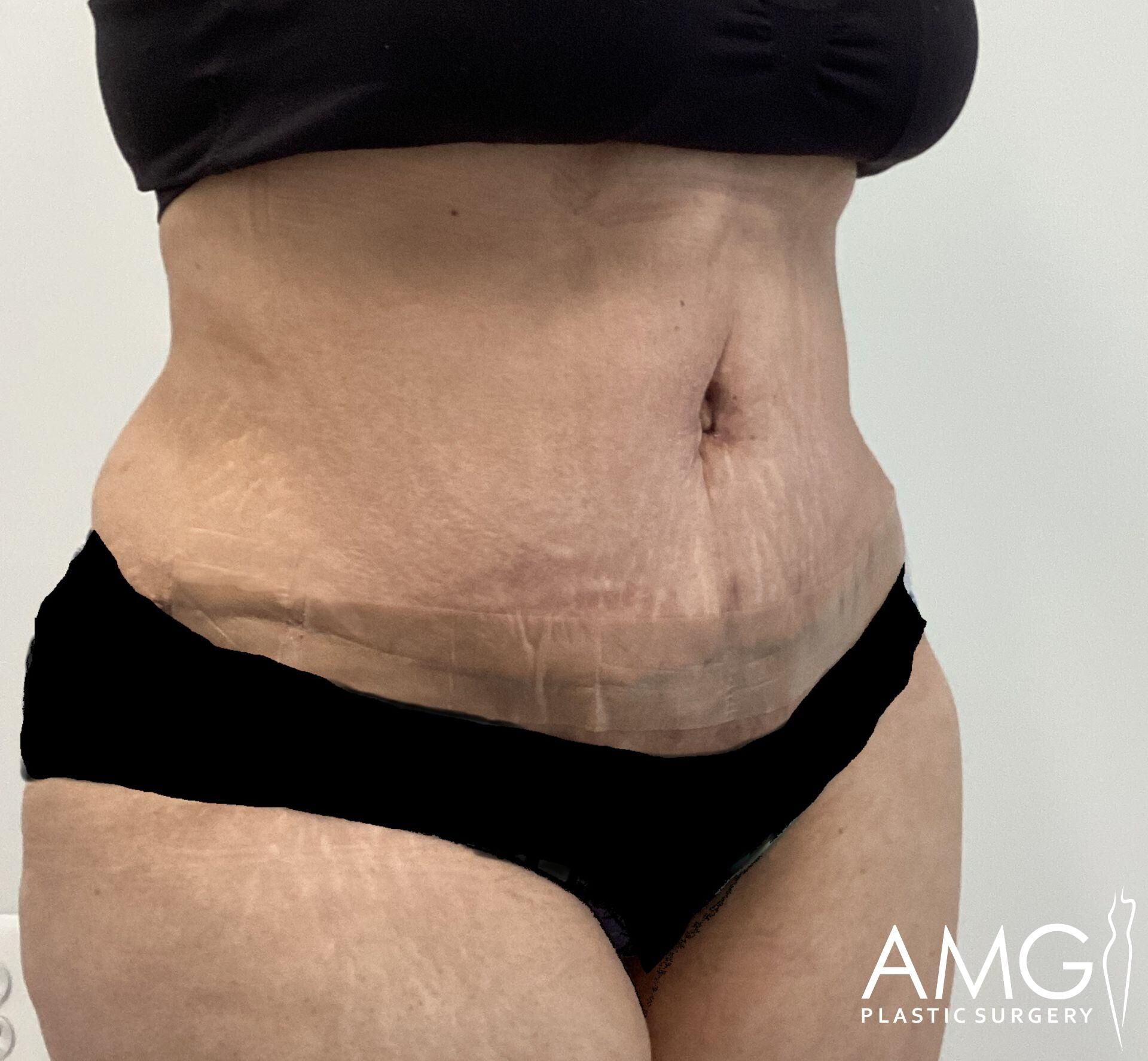 A person in black underwear showing a torso with visible stretch marks and skin texture. Logo in the bottom right corner reads "AMG Plastic Surgery.