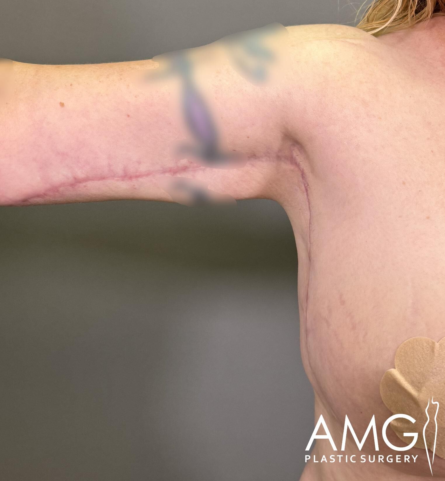 Close-up of a person's arm and torso showing a surgical scar. Logo "AMG Plastic Surgery" is in the lower right corner.