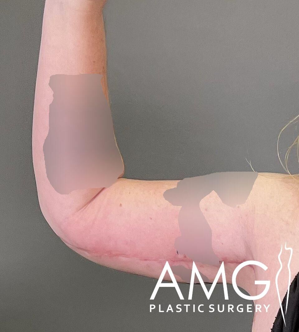 A post-surgery image shows the underside of a person's arm with visible scarring. Branding in the corner reads "AMG Plastic Surgery.