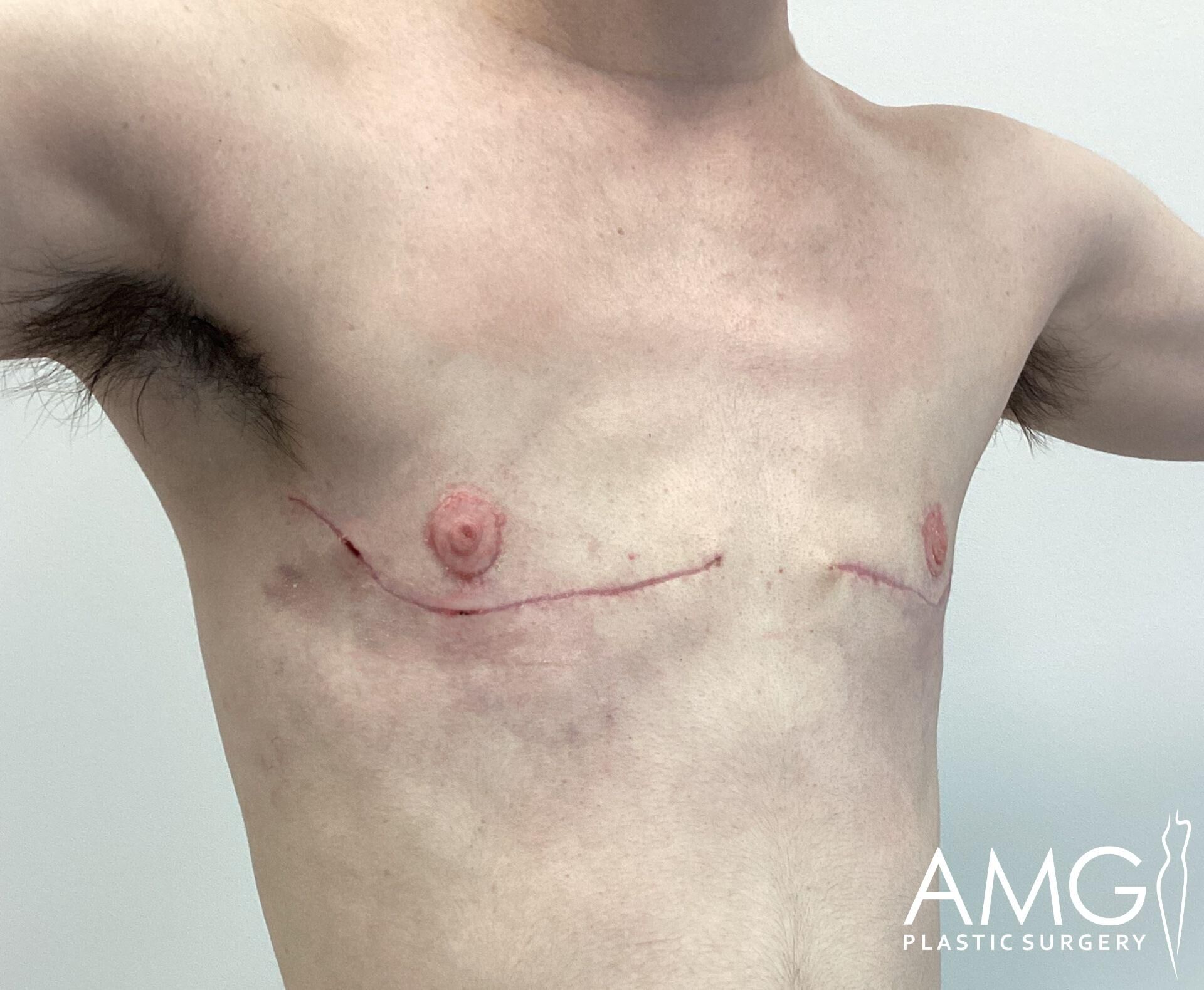 Person's chest showing post-surgery scars beneath the nipples, with faint surgical marker lines. Logo in the bottom right reads "AMG Plastic Surgery.
