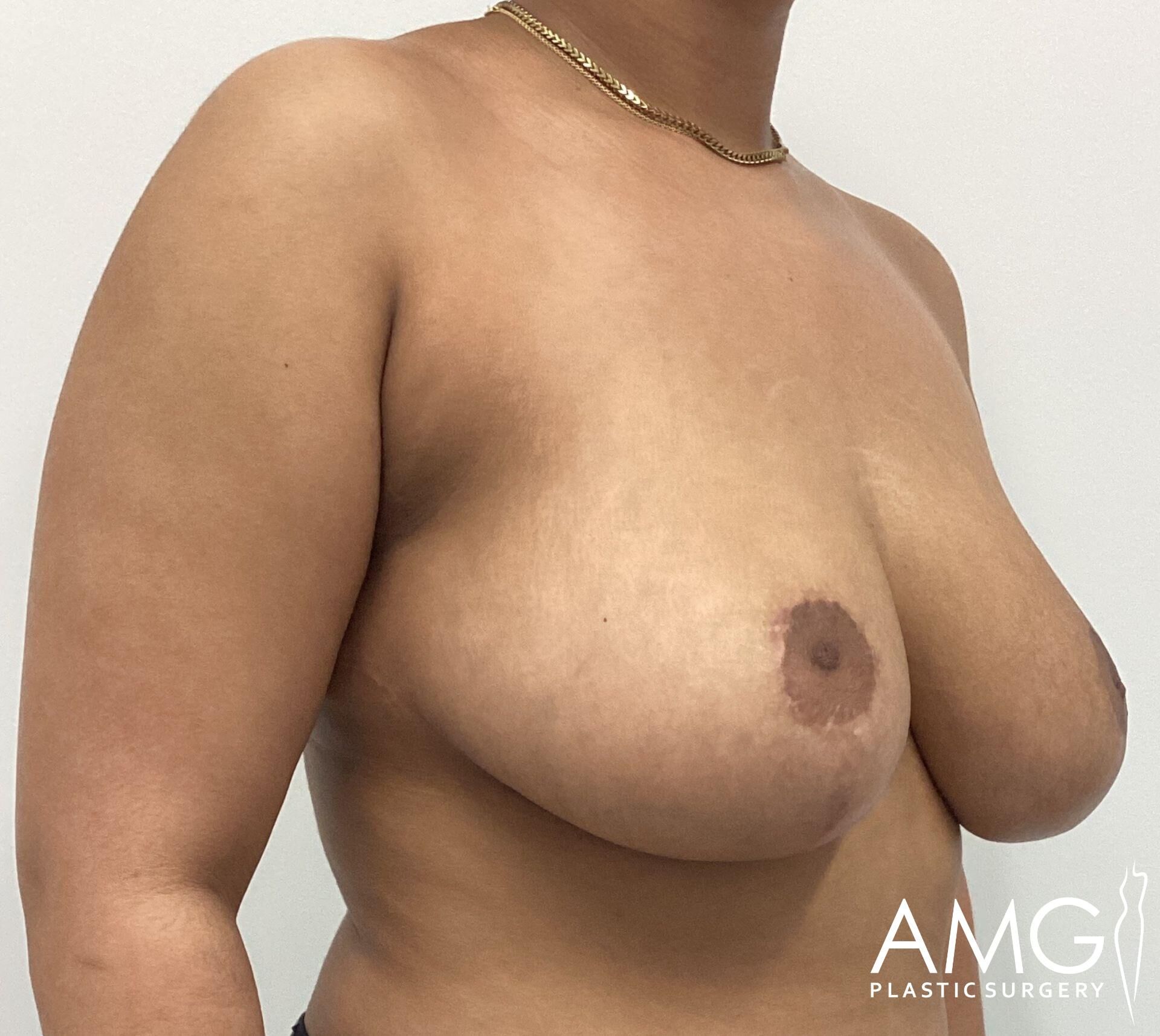 A person with a visible chest and shoulder stands against a plain background, wearing a necklace. The image is branded with a logo in the bottom right corner reading "AMG Plastic Surgery.