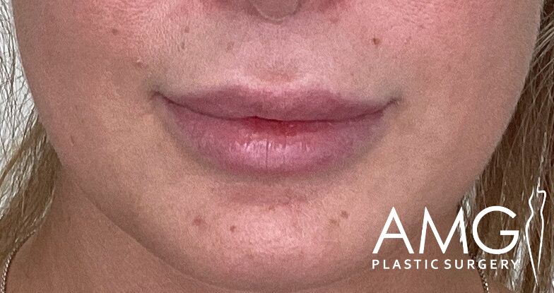 Close-up of a person's lips with visible skin texture and pimples. "AMG Plastic Surgery" logo is in the bottom right corner.