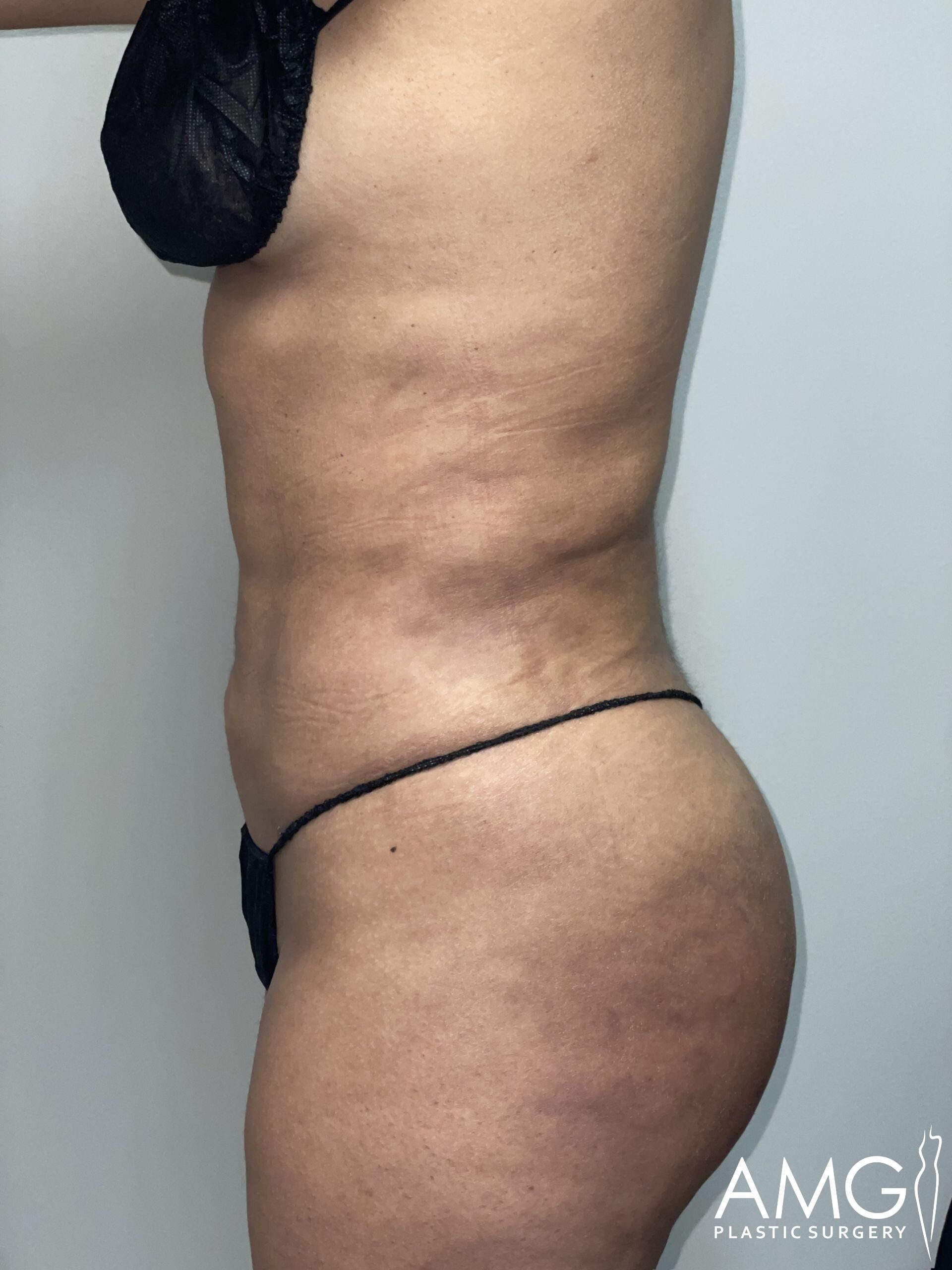 Side view of a person's torso showing midsection and upper leg in black undergarments against a neutral background. The image includes AMG Plastic Surgery branding in the lower right corner.