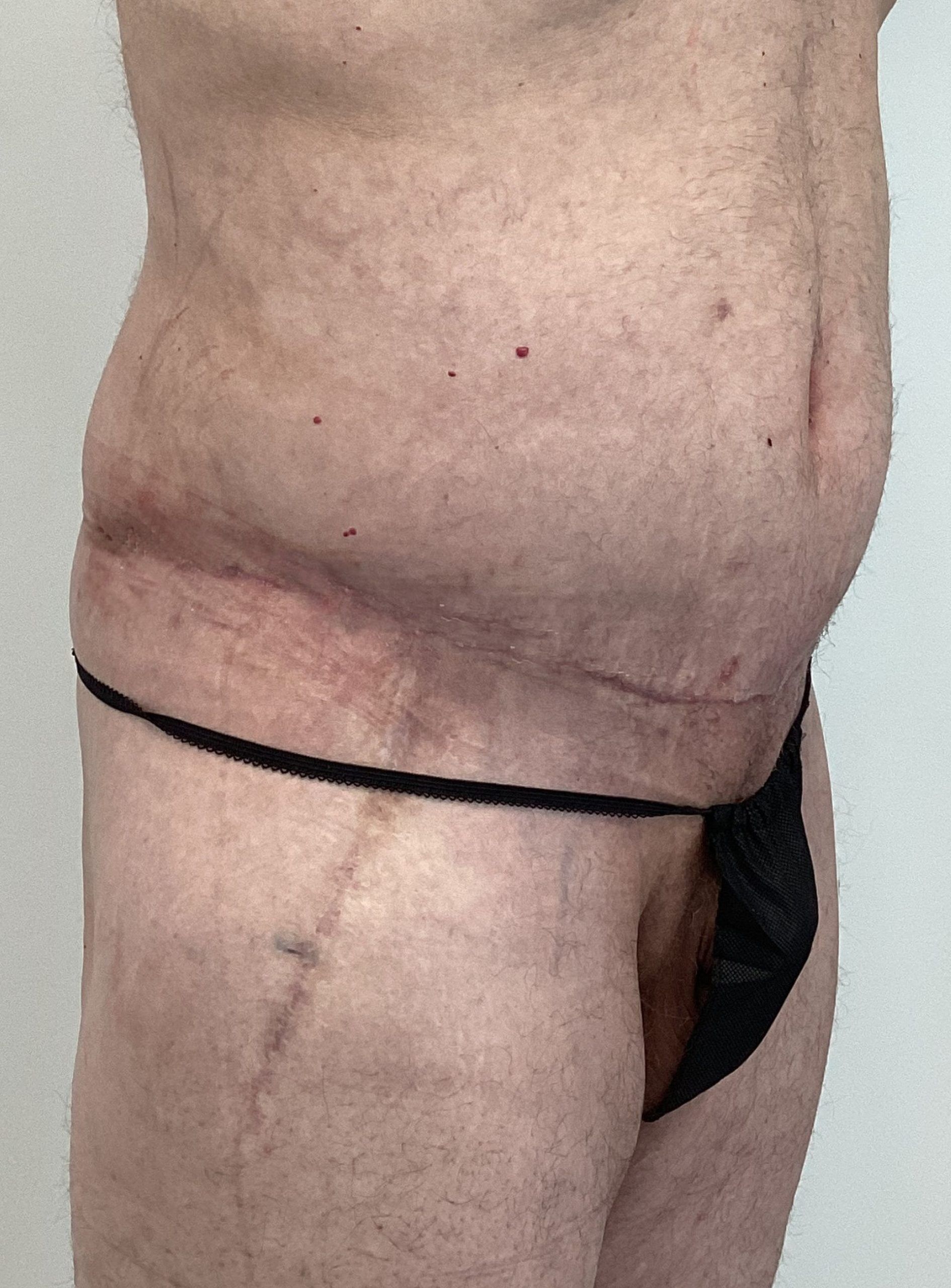 Side view of a person with visible surgical scars on the abdomen and hips, wearing minimal black undergarments. "AMG Plastic Surgery" text is visible in the corner.