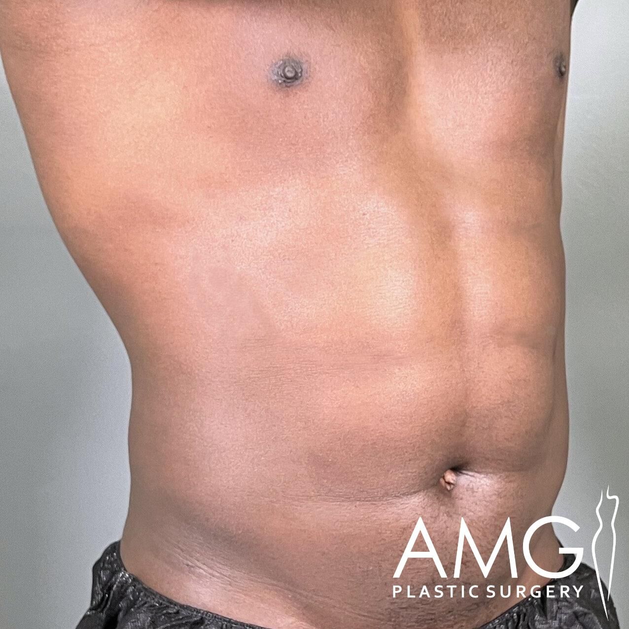 Close-up of a bare, muscular male torso with visible abs. The image displays the logo "AMG Plastic Surgery" in the lower right corner.