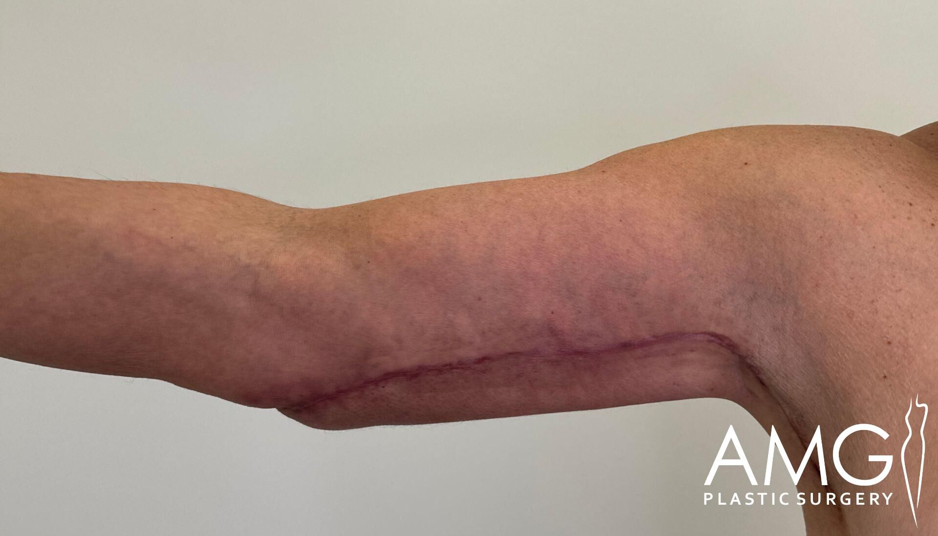 Close-up of a person's upper arm showing a long, healed scar running from the elbow to the armpit. The skin is slightly discolored along the scar line.