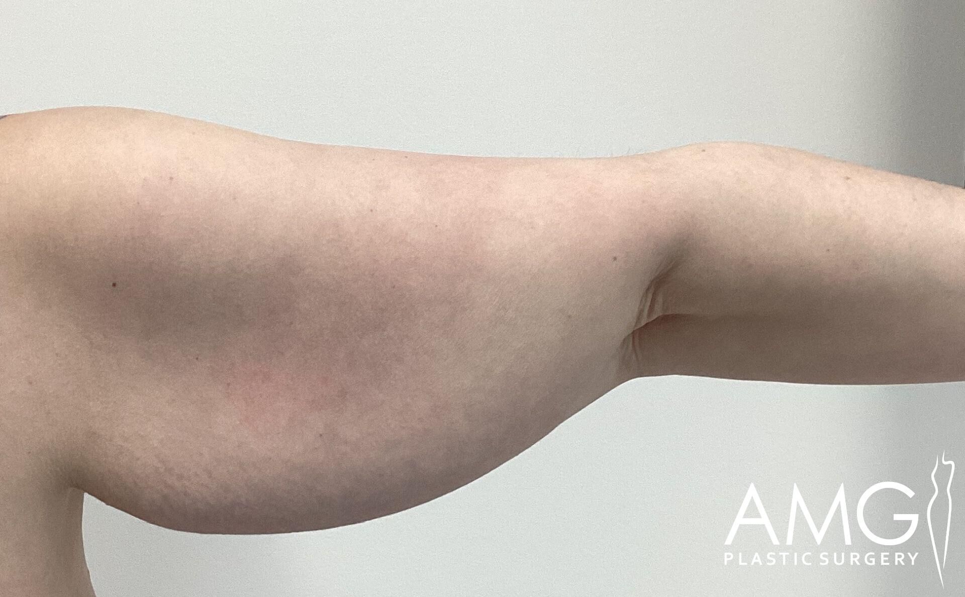 A close-up of an extended arm with loose skin near the triceps area, against a neutral background.