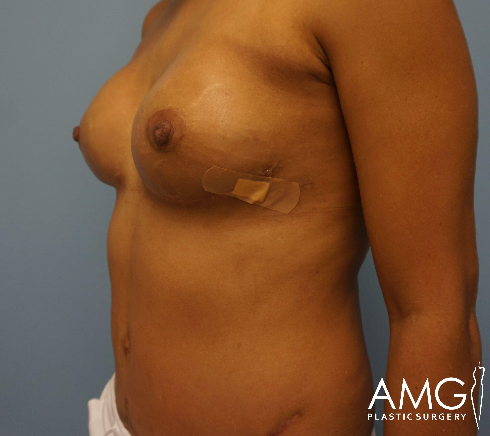 A person with a bandage under their left breast, shown from the torso up, against a blue background.