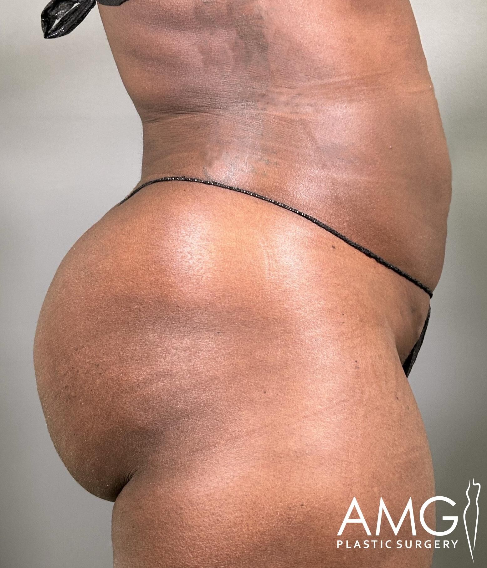 Side view of a person wearing a black thong, with a focus on the hip and waist area. The logo "AMG Plastic Surgery" is visible in the corner.