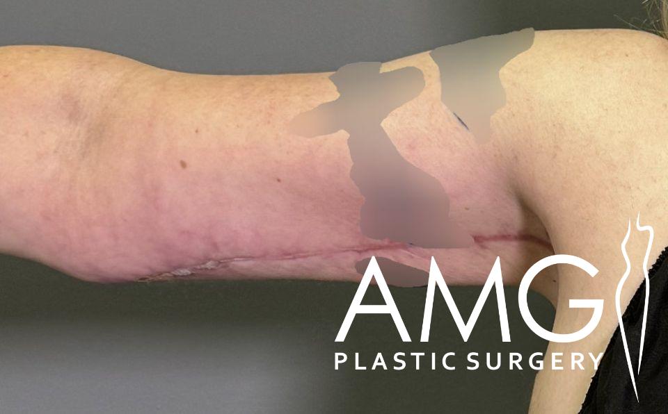 A person's arm showing a surgical scar extending from the armpit along the upper arm. AMG Plastic Surgery logo is visible.