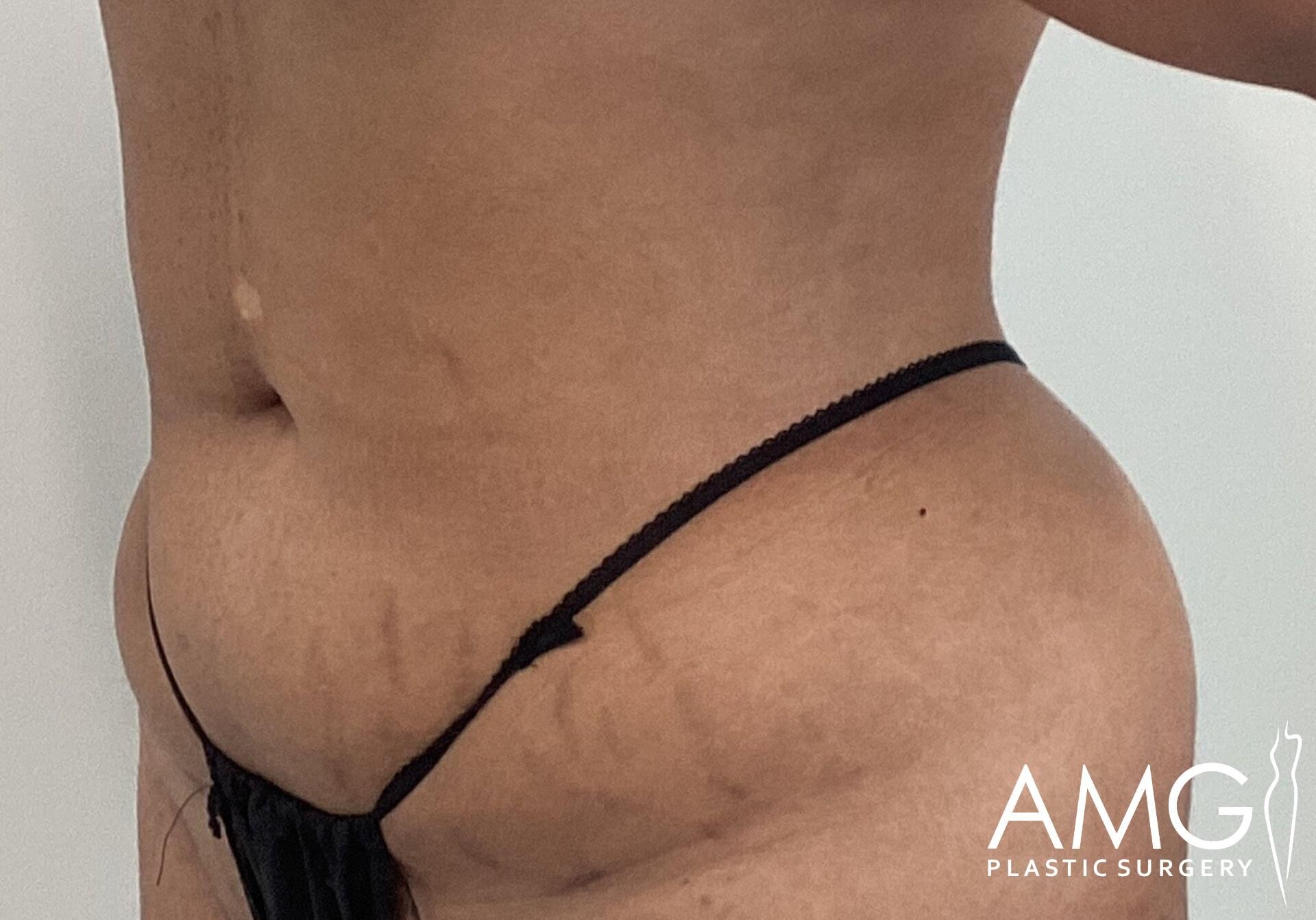 Close-up of a person's lower body with visible stretch marks and an AMG Plastic Surgery watermark in the corner.