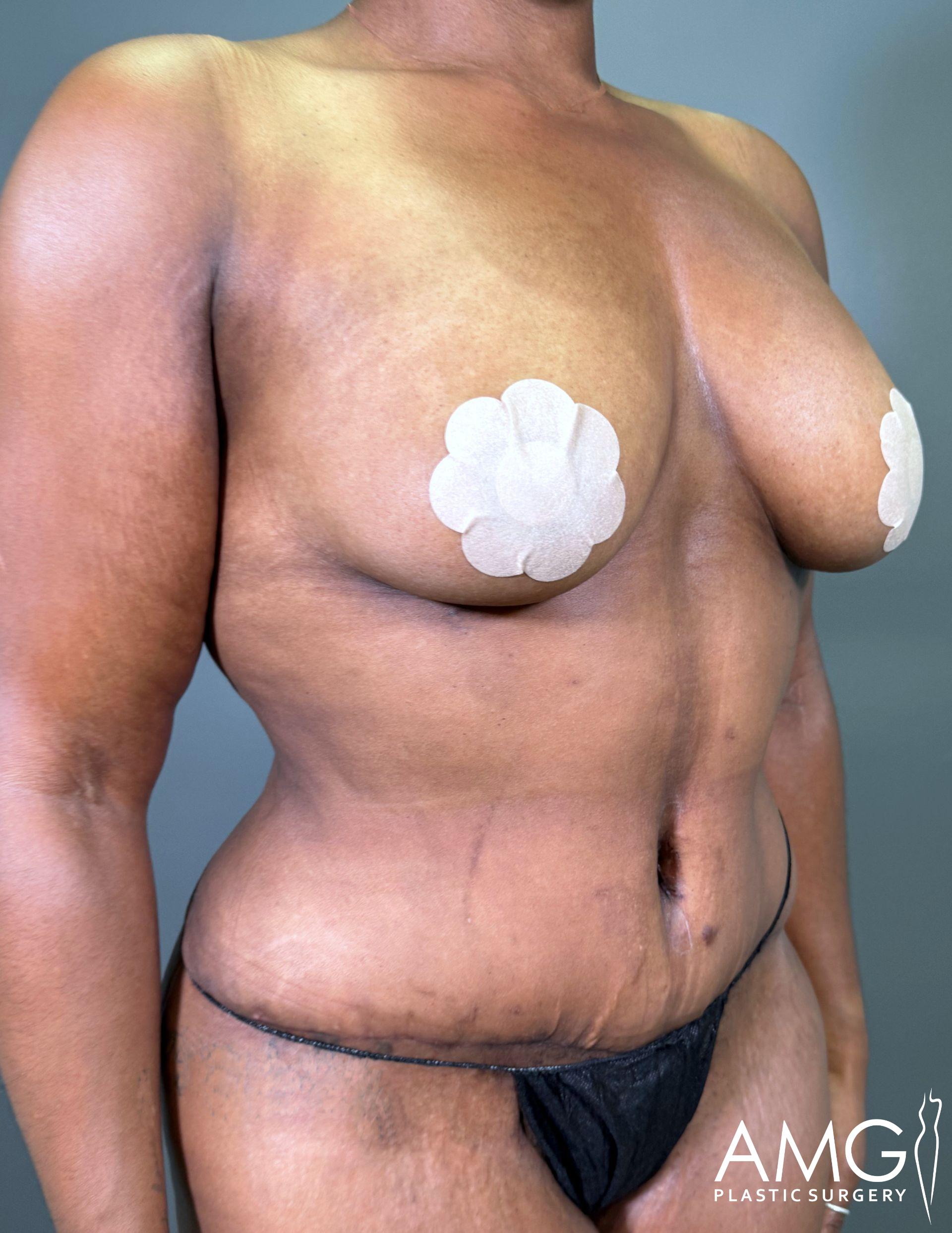 A person wearing adhesive covers on their chest poses in black underwear against a neutral background.