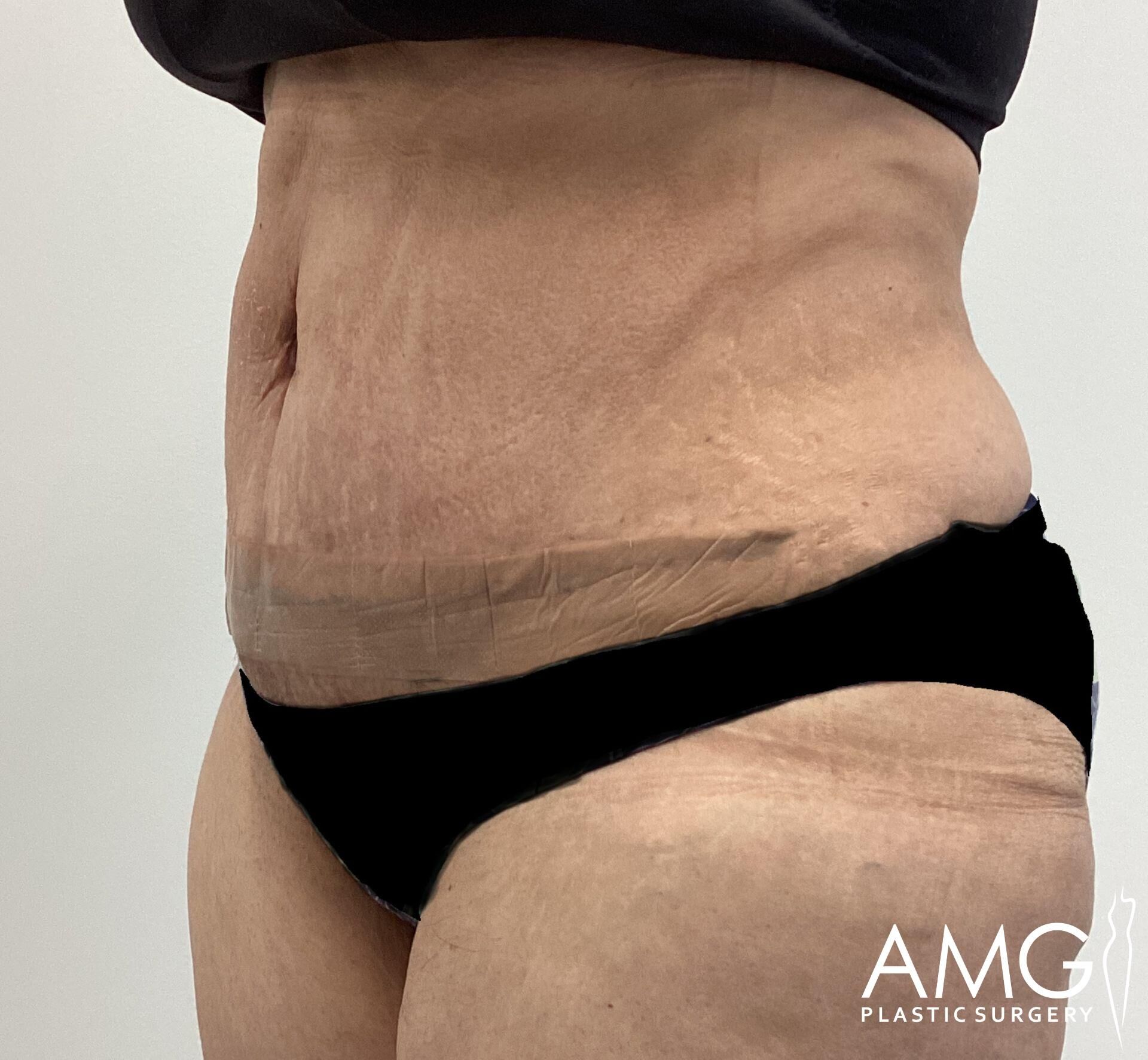 Close-up of a person's abdomen and hip area, showing the skin's texture and an underwear line. The logo "AMG Plastic Surgery" is in the bottom right corner.