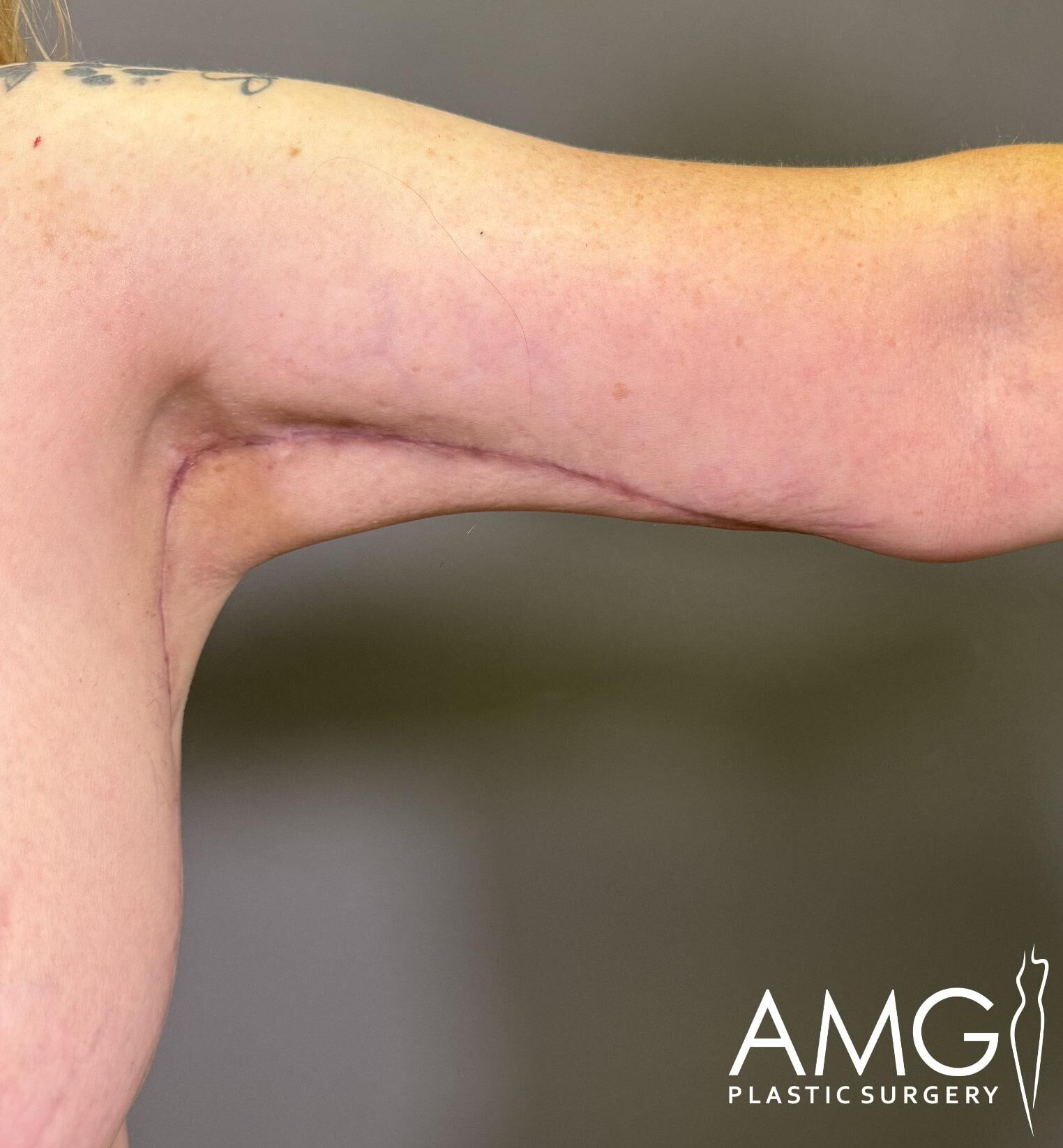 Close-up of a person's arm showing a surgical scar. The background is a plain gray color. "AMG Plastic Surgery" logo is visible at the bottom right.
