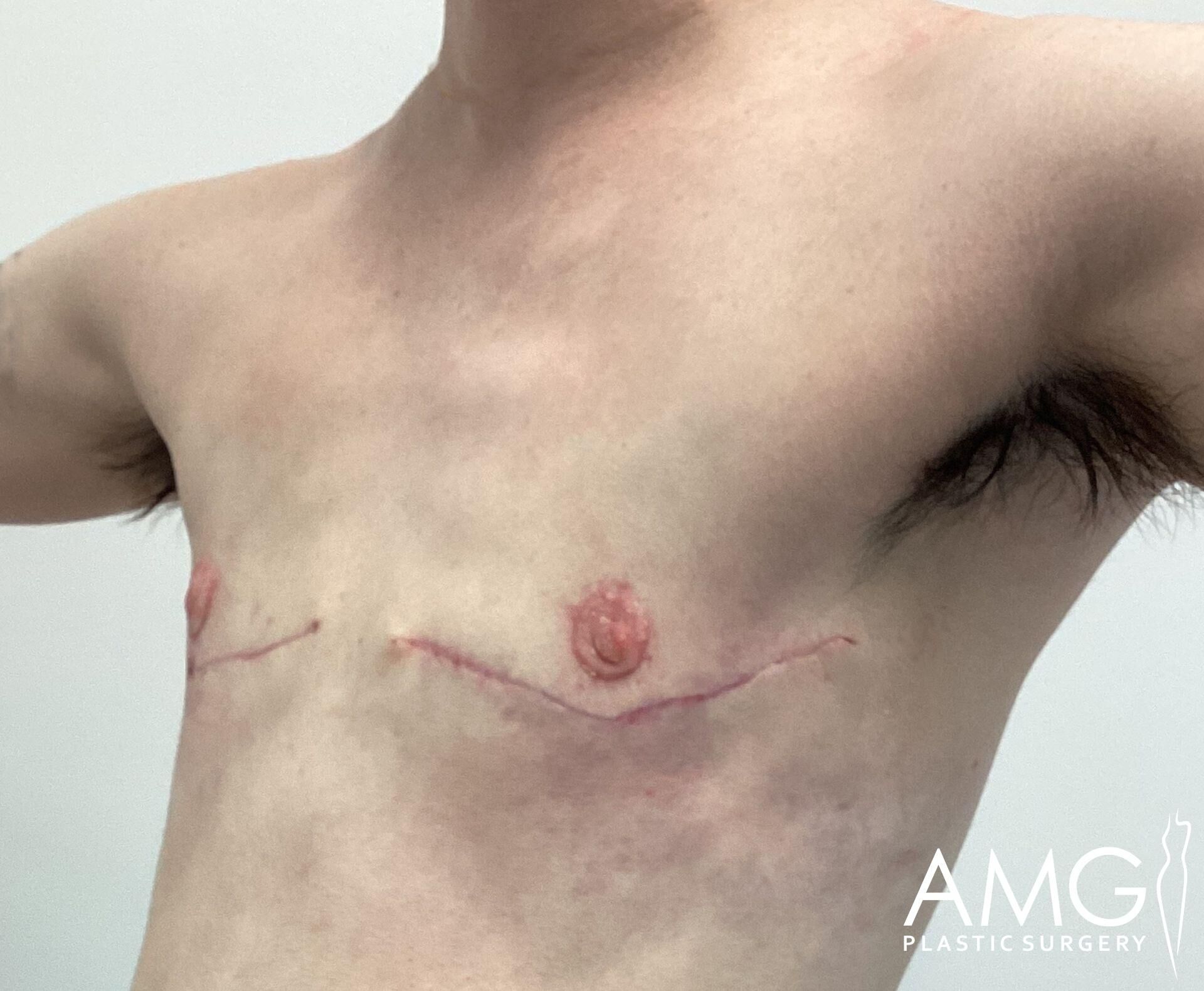 Person with healing chest scars after surgery, arms raised.