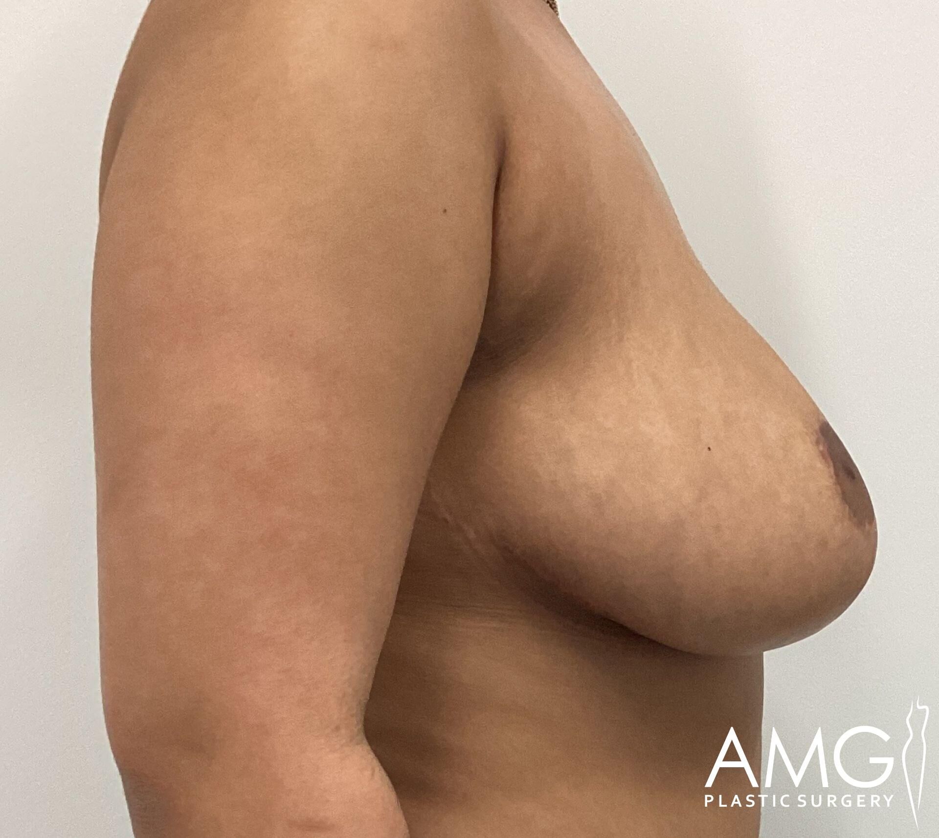 Side view of a person's torso displaying a natural breast profile against a plain background, with a logo in the corner.