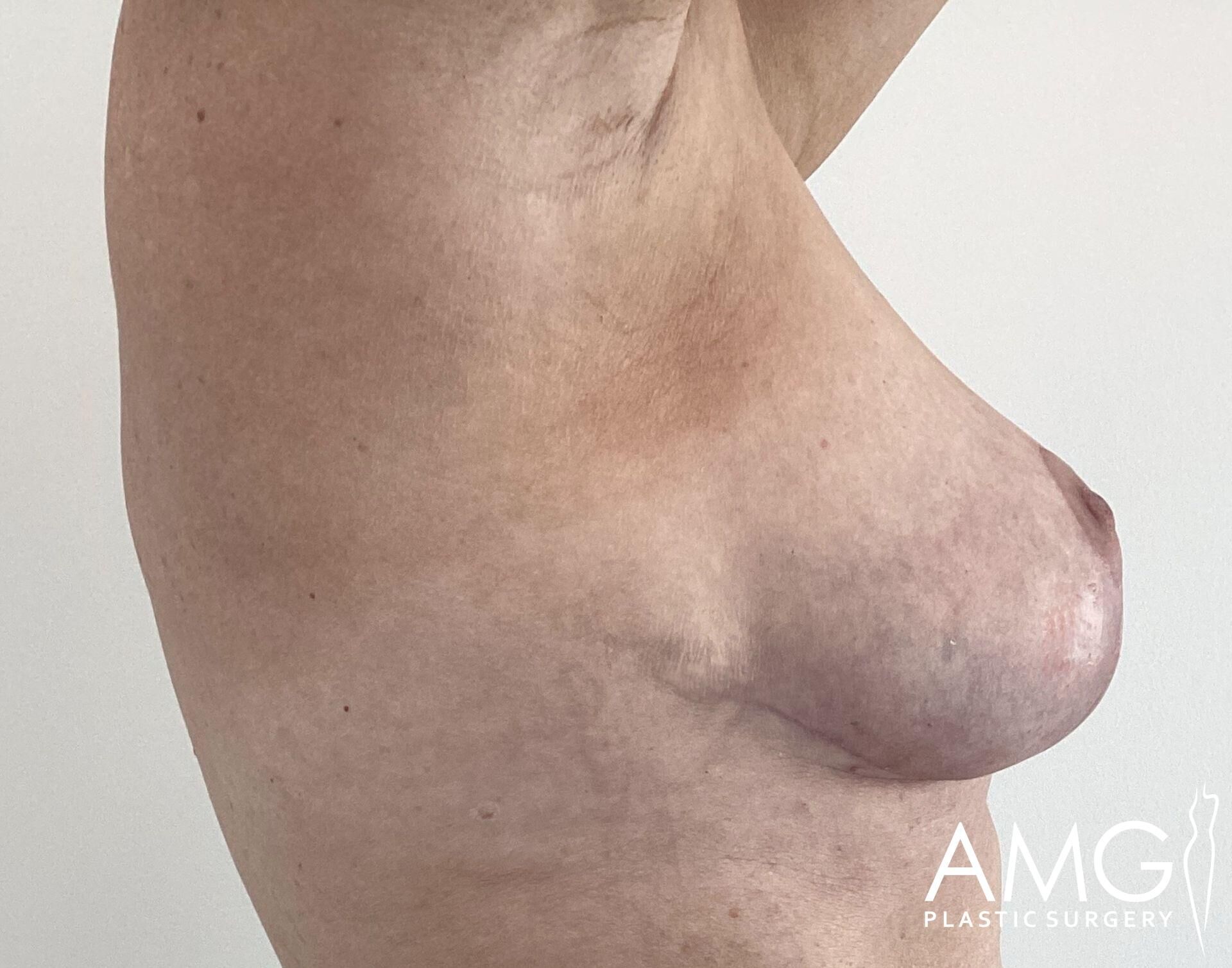 Side view of a person's chest and abdomen with visible sagging skin. Plain background and AMG Plastic Surgery logo in the corner.