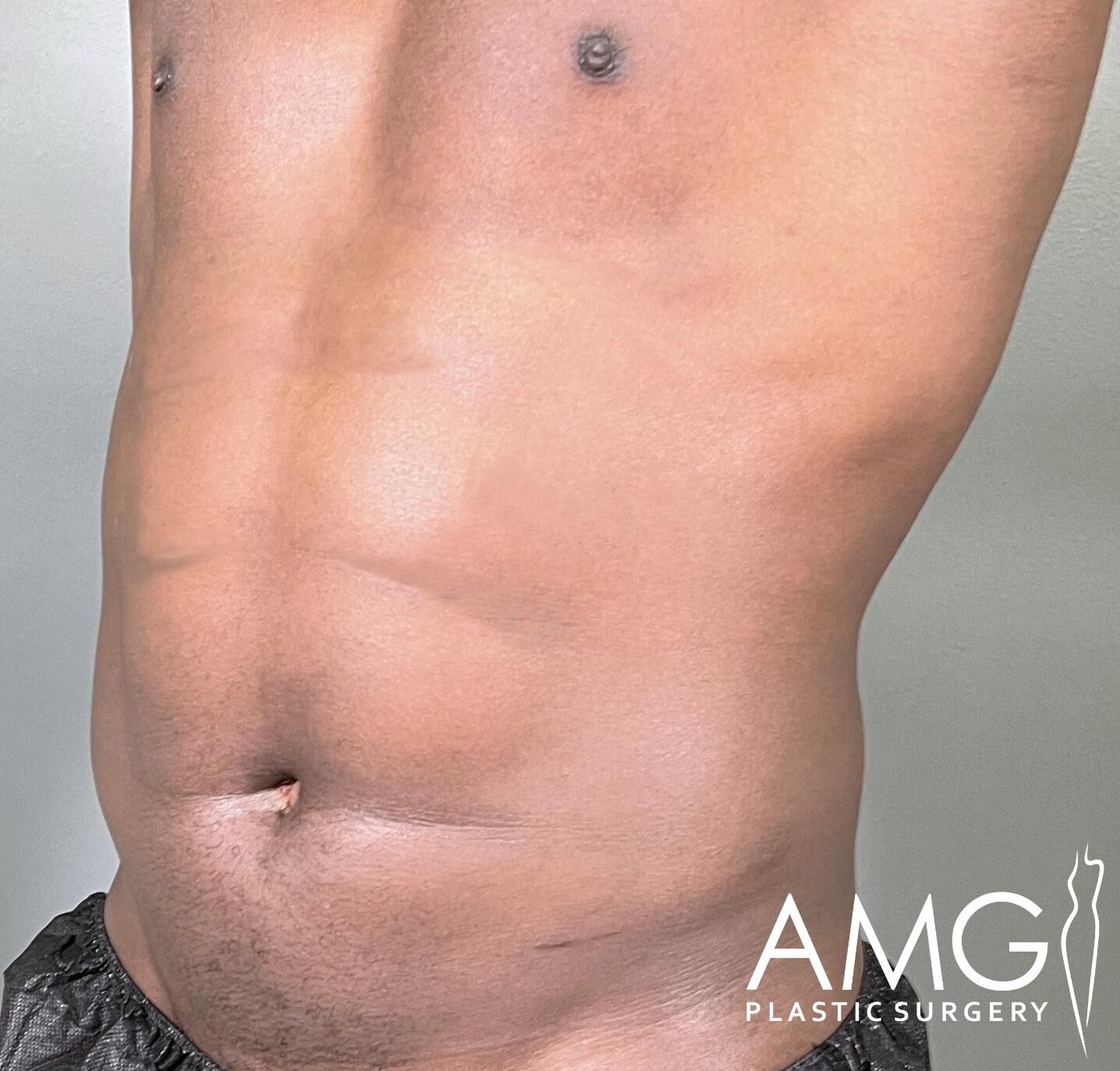 Close-up of a person's abdominal area showing skin texture and contour. The logo "AMG Plastic Surgery" is in the lower right corner.