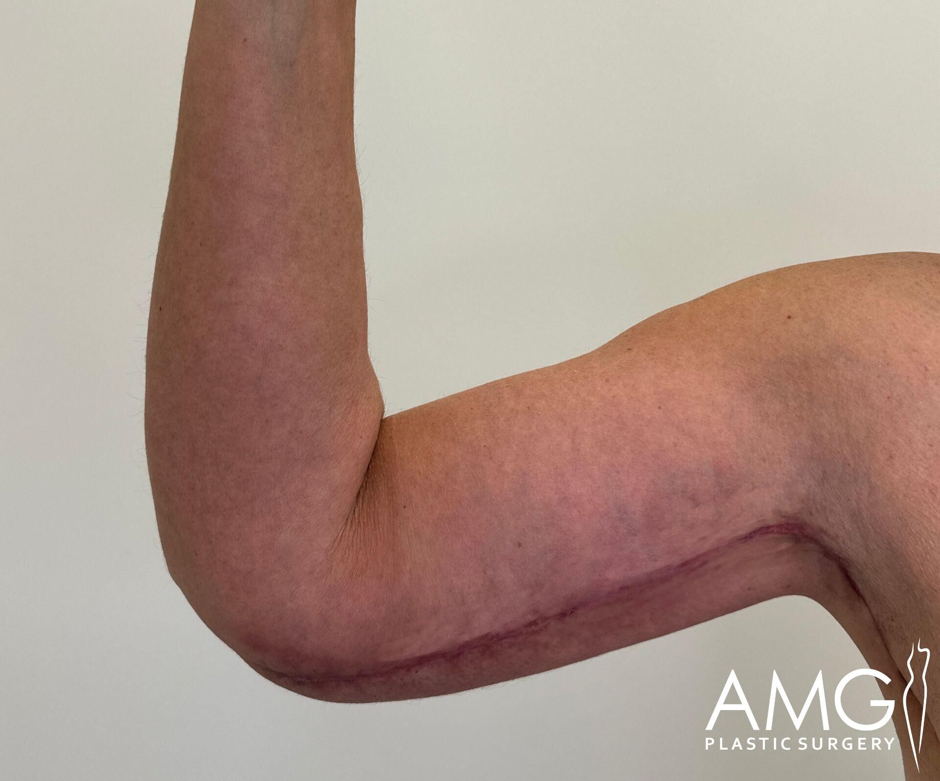 An arm bent at the elbow displaying a prominent scar along the inner bicep against a neutral background.