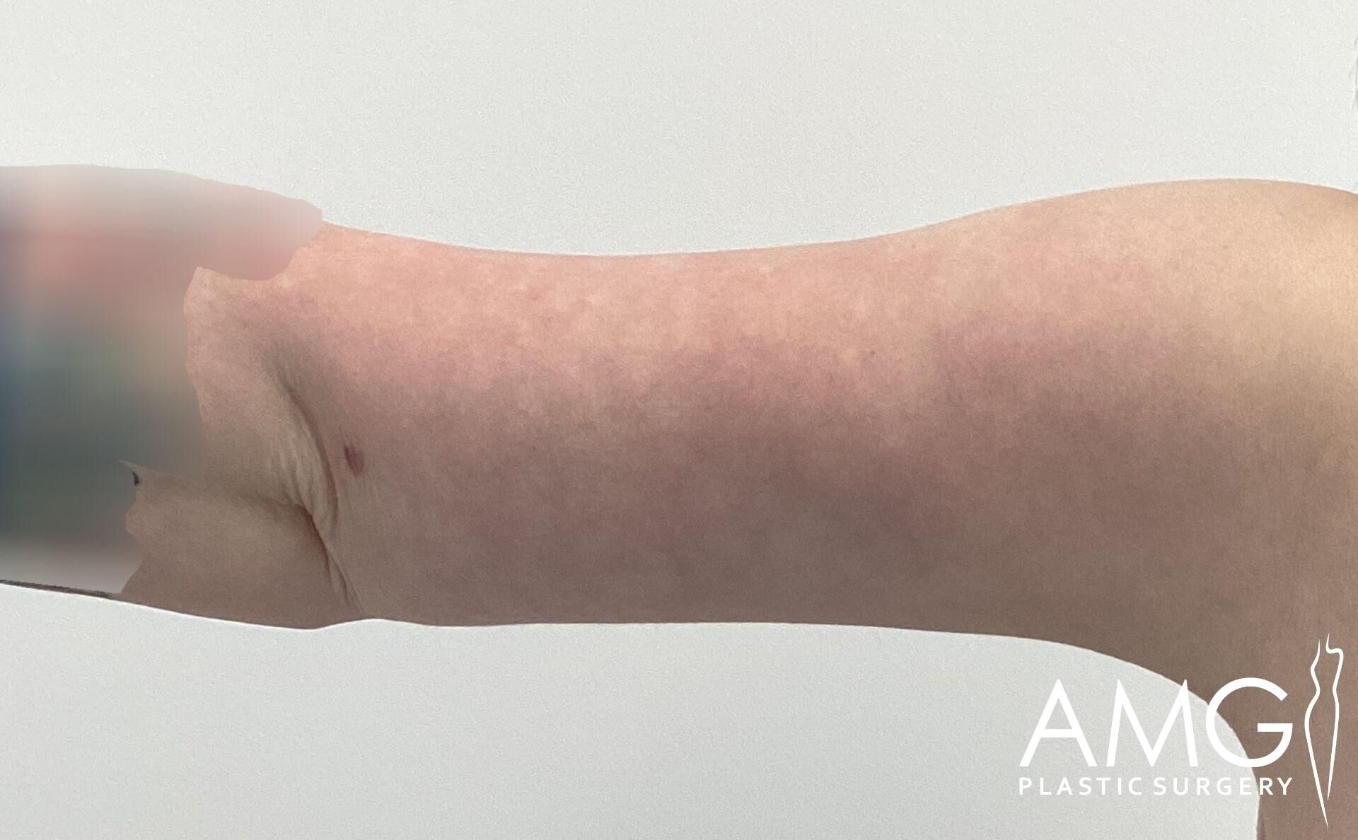 Close-up of a human arm revealing loose skin, with the AMG Plastic Surgery logo in the bottom right corner.