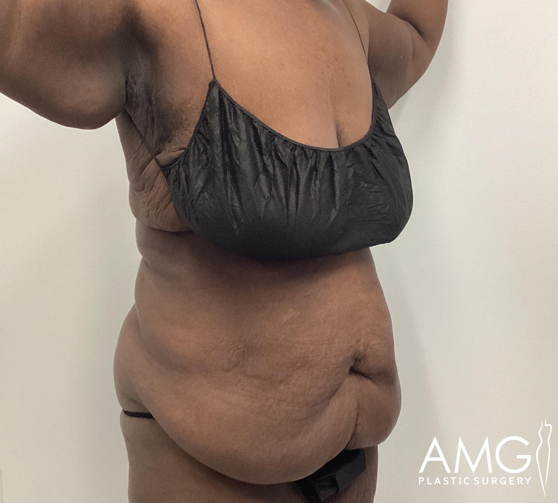 Person standing with arms raised, showing the side view of their torso wearing a black garment. "AMG Plastic Surgery" logo visible in the corner.
