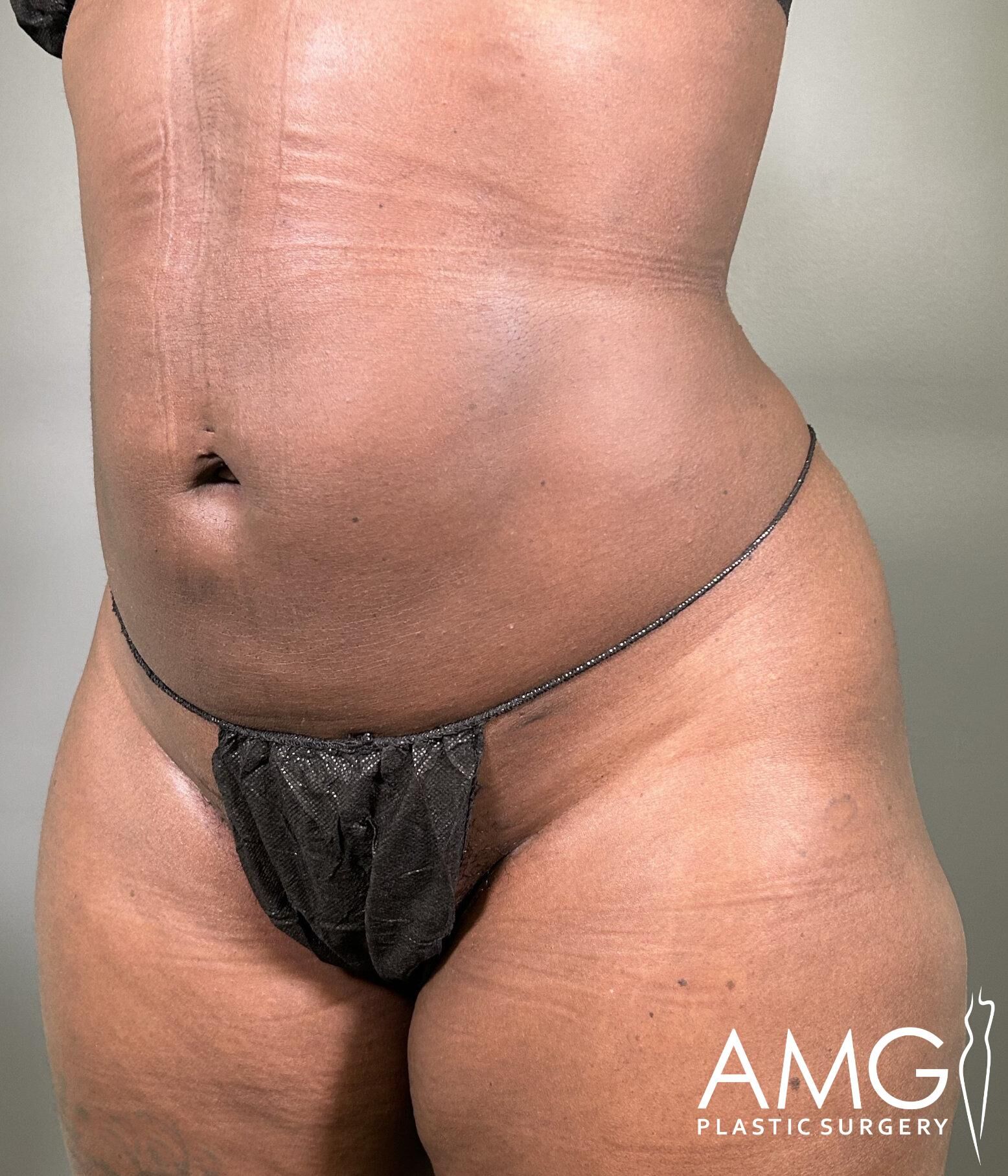 Close-up of a person’s waist and abdomen, highlighting skin texture. They are wearing black underwear. "AMG Plastic Surgery" is labeled in the bottom right corner.