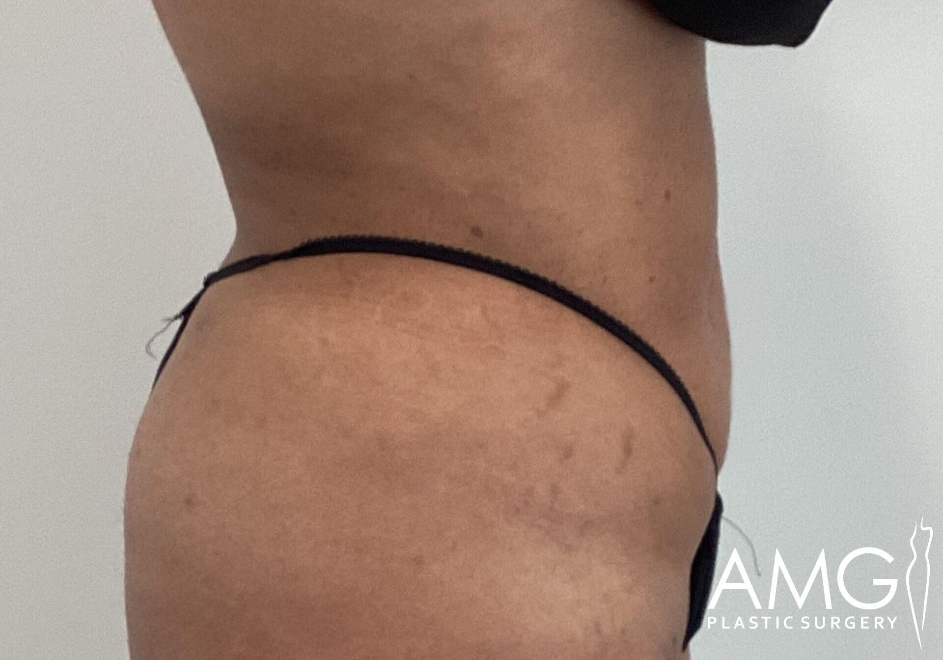 Side view of a person's torso wearing black underwear, with stretch marks visible on the skin. Logo in the bottom right corner reads "AMG Plastic Surgery.