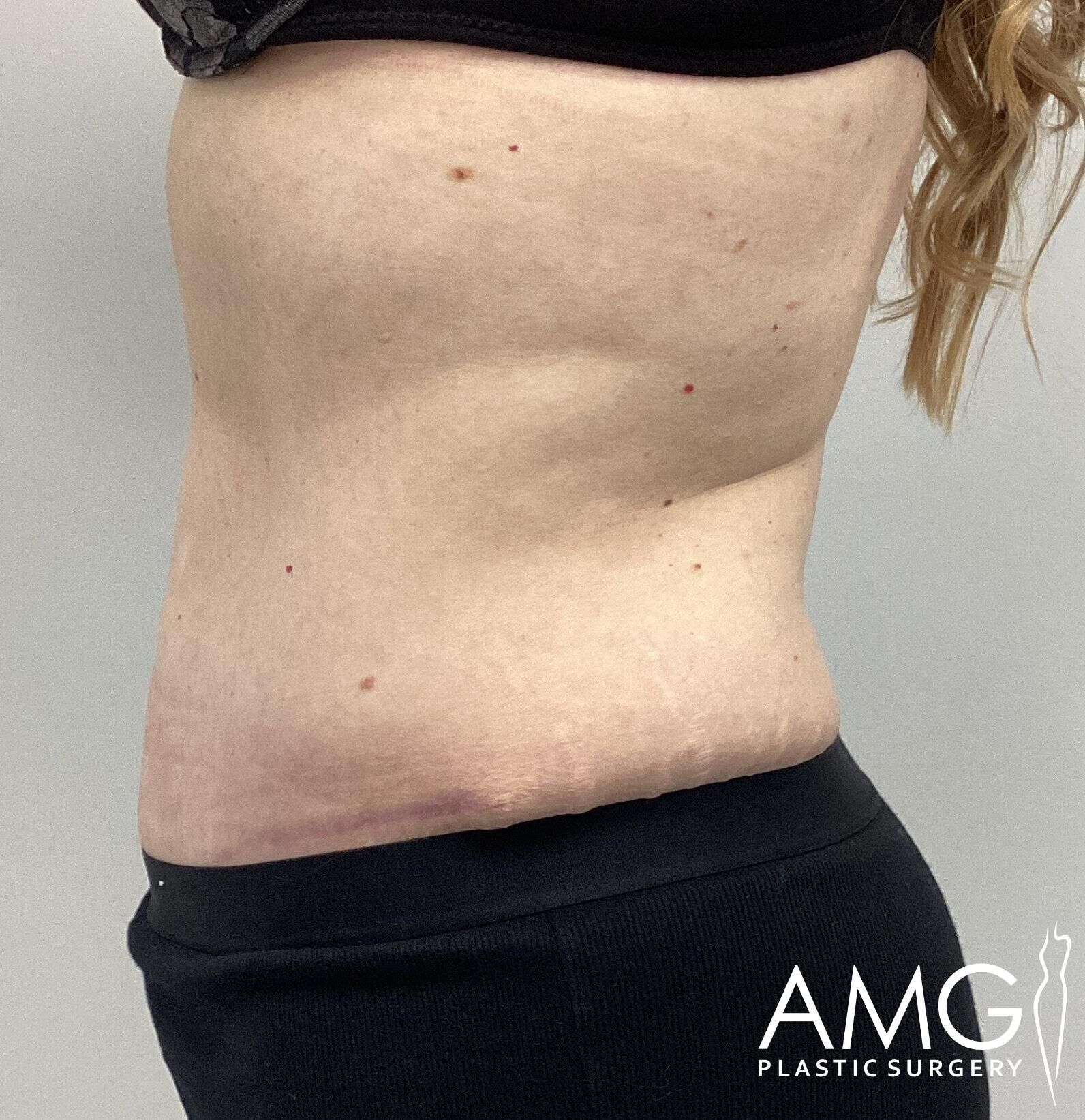 Side view of a person's midsection showing a post-surgery skin area, wearing black pants and a dark top. Logo in the bottom right reads "AMG Plastic Surgery.