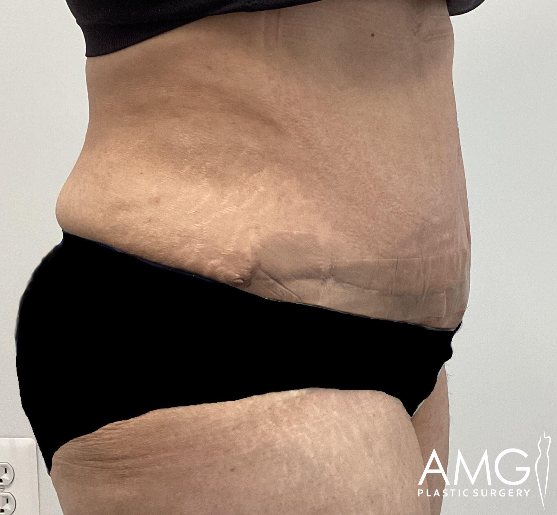 Profile view of a person's abdomen showing skin folds and stretch marks. Black undergarment visible. Logo "AMG Plastic Surgery" in lower right corner.