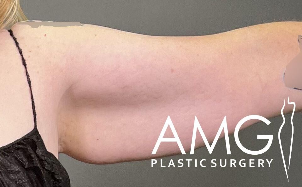 Close-up of a person's arm with a logo reading "AMG Plastic Surgery" overlaid at the bottom right corner.